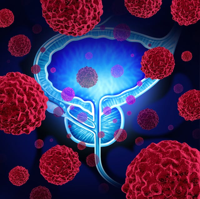 Opdivo Gets FDA Nod as Adjuvant Therapy for Muscle-Invasive Urothelial Cancer