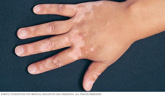 FDA Extends Review of Opzelura for Skin Condition