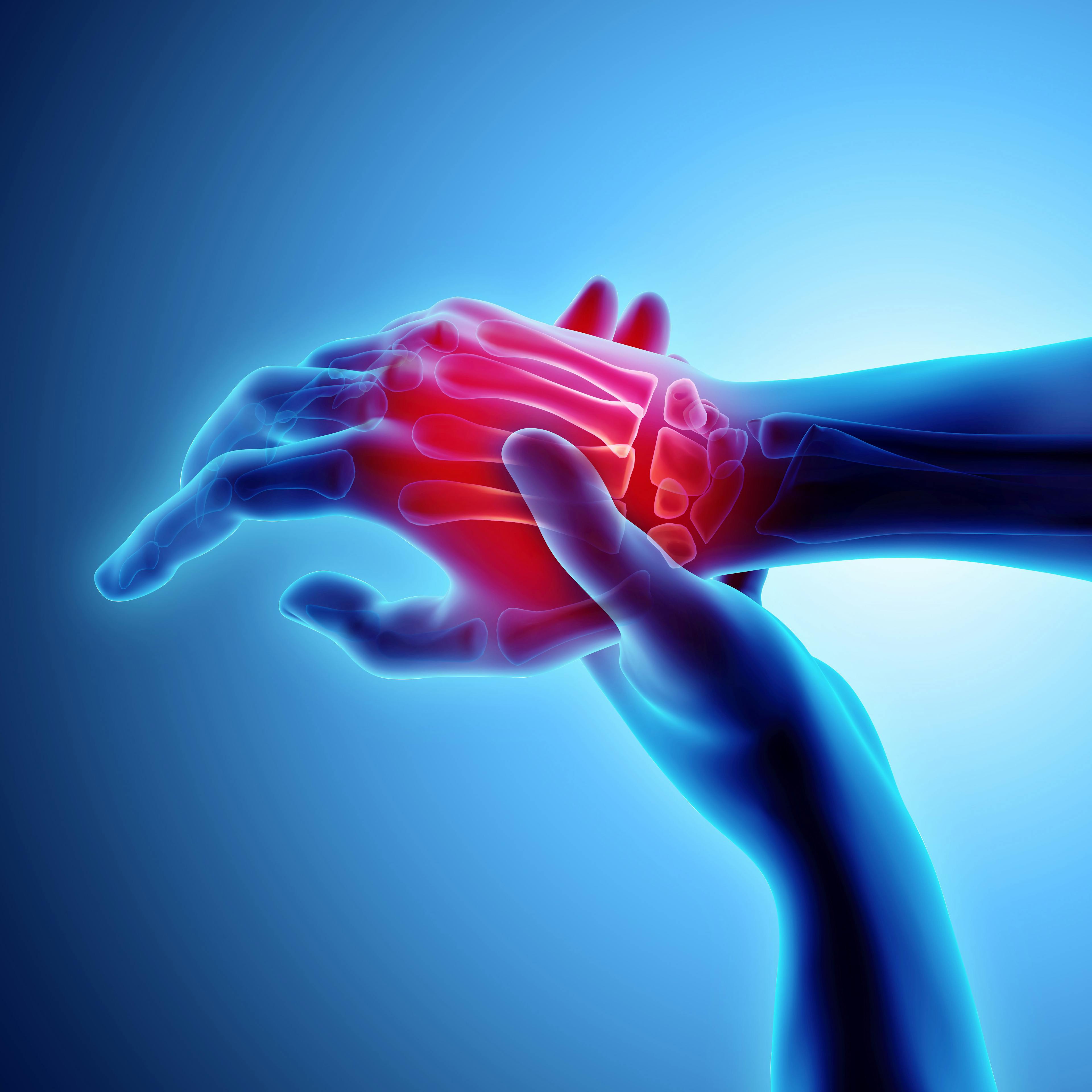 Researchers Believe KLK6 Protein May Play a Role in the Development of Psoriatic Arthritis
