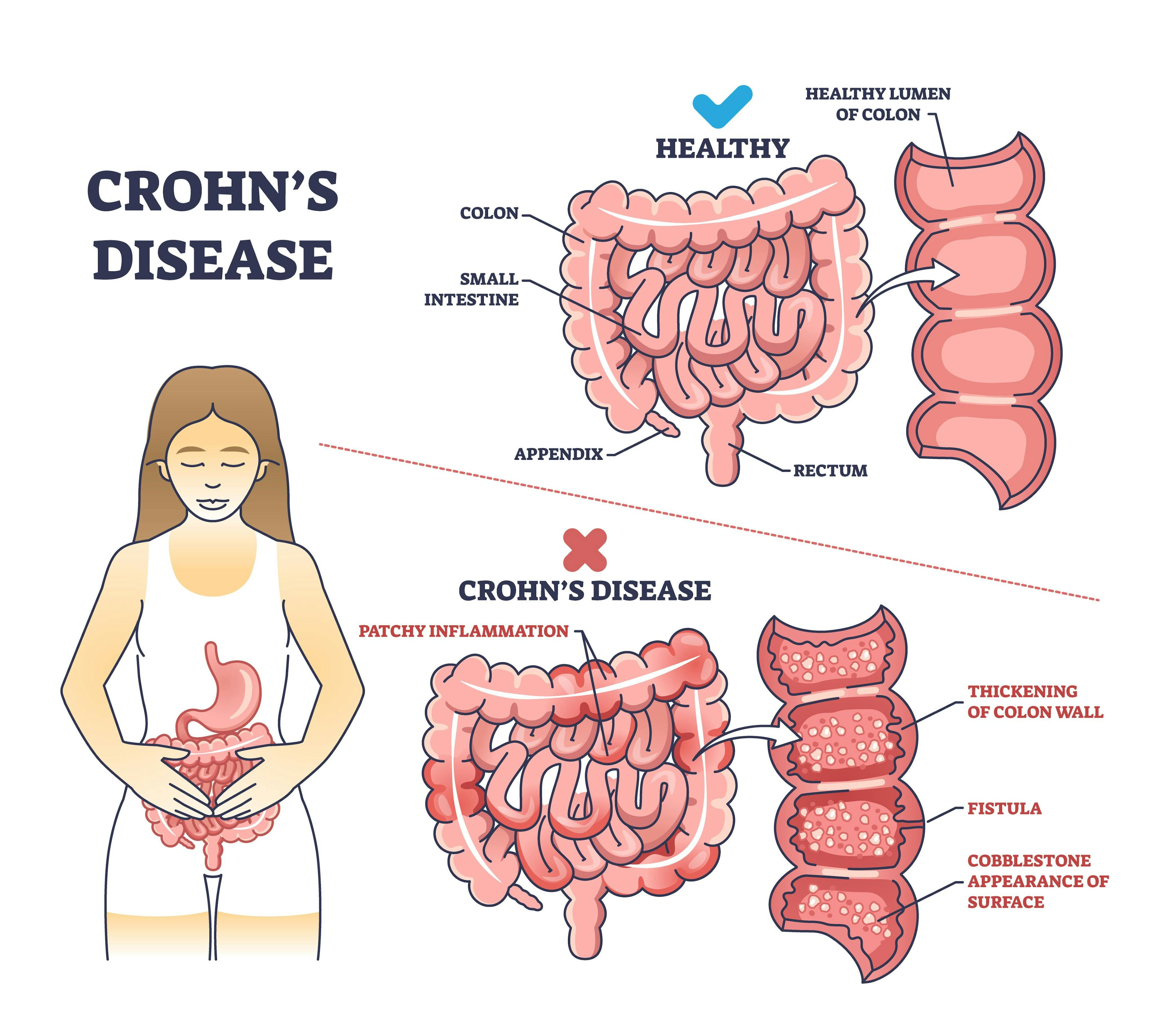 The Prevalence, Incidence of One of the Most Unwanted Complications of Crohn’s Disease: Fistulas