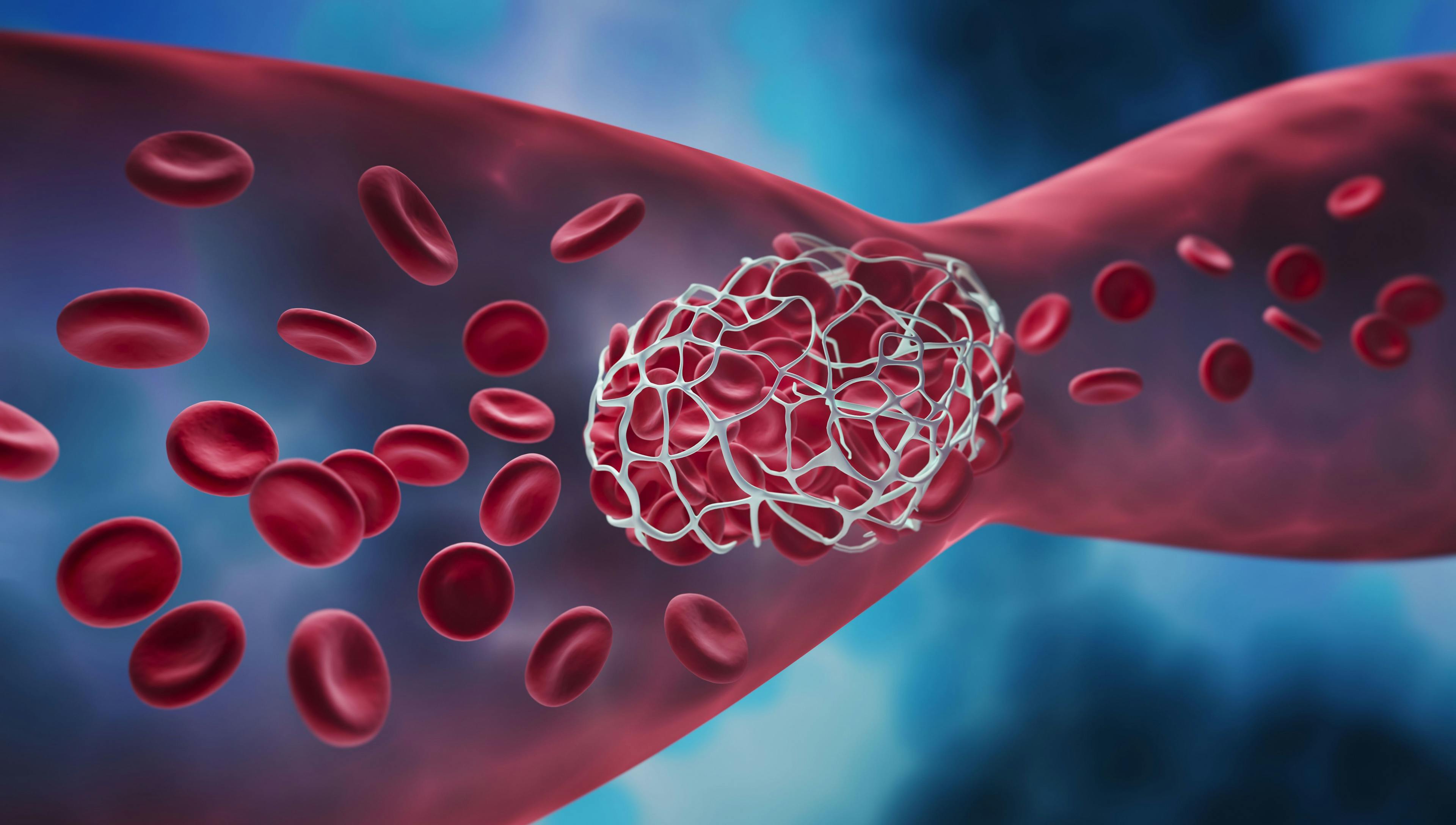Study: Thrombotic Events Increase Mortality Risk for People With Polycythemia Vera or Essential Thrombocythemia