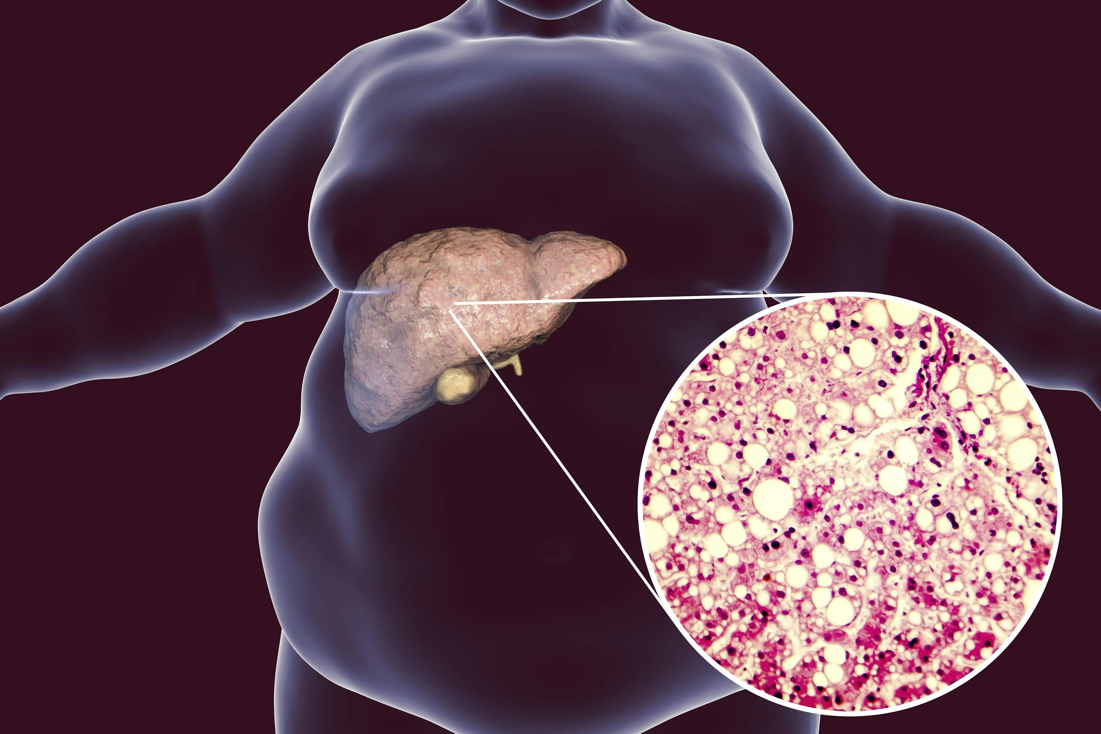 Advances in Nonalcoholic Fatty Liver Disease Unveiled at International Liver Congress