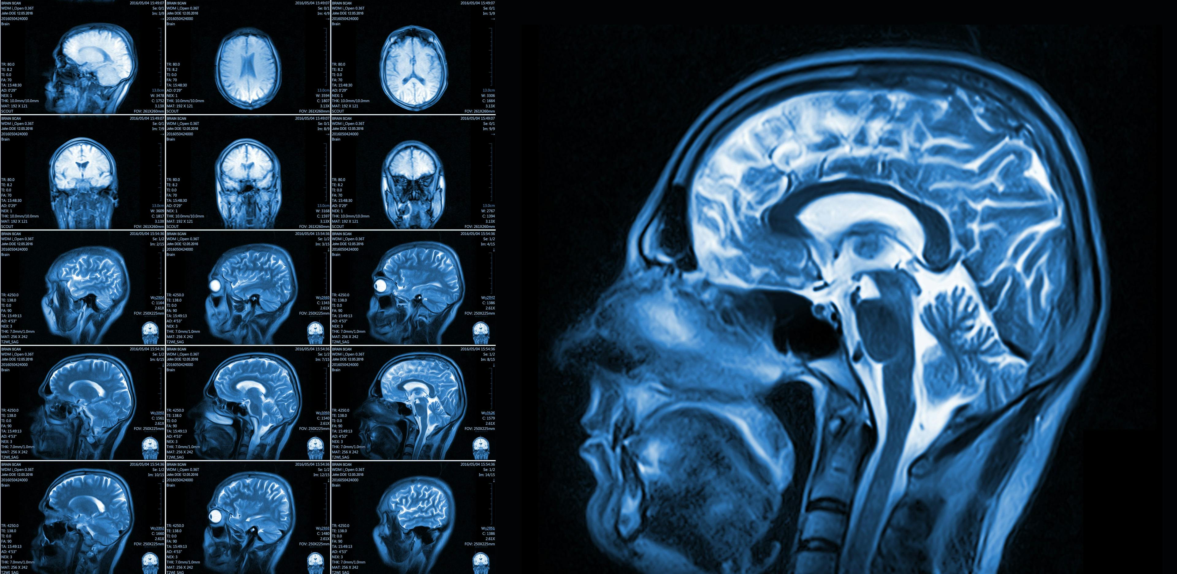 MRI images of the brain | Image credit: Maxim p stock.adobe.come