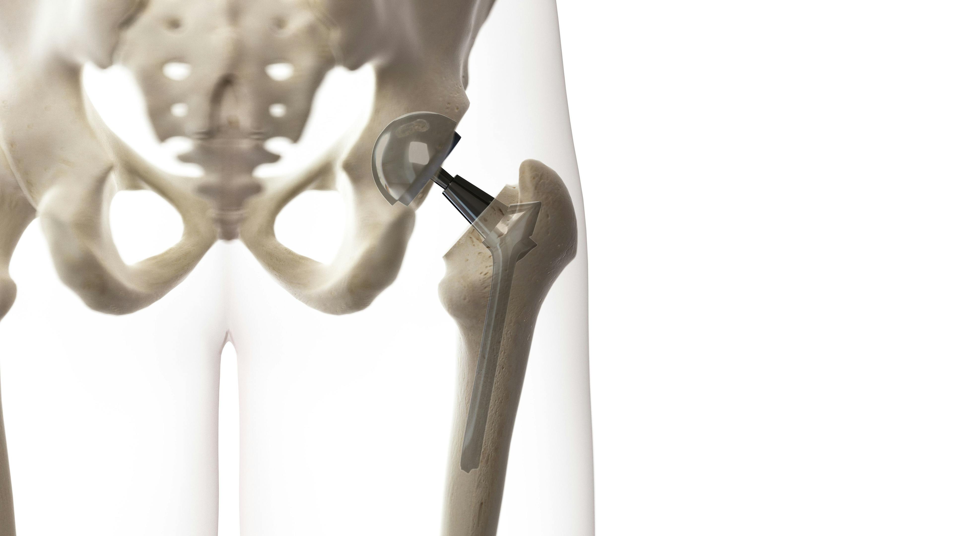 hip replacement skeleton | Image credit sciepro   stock.adobe.com