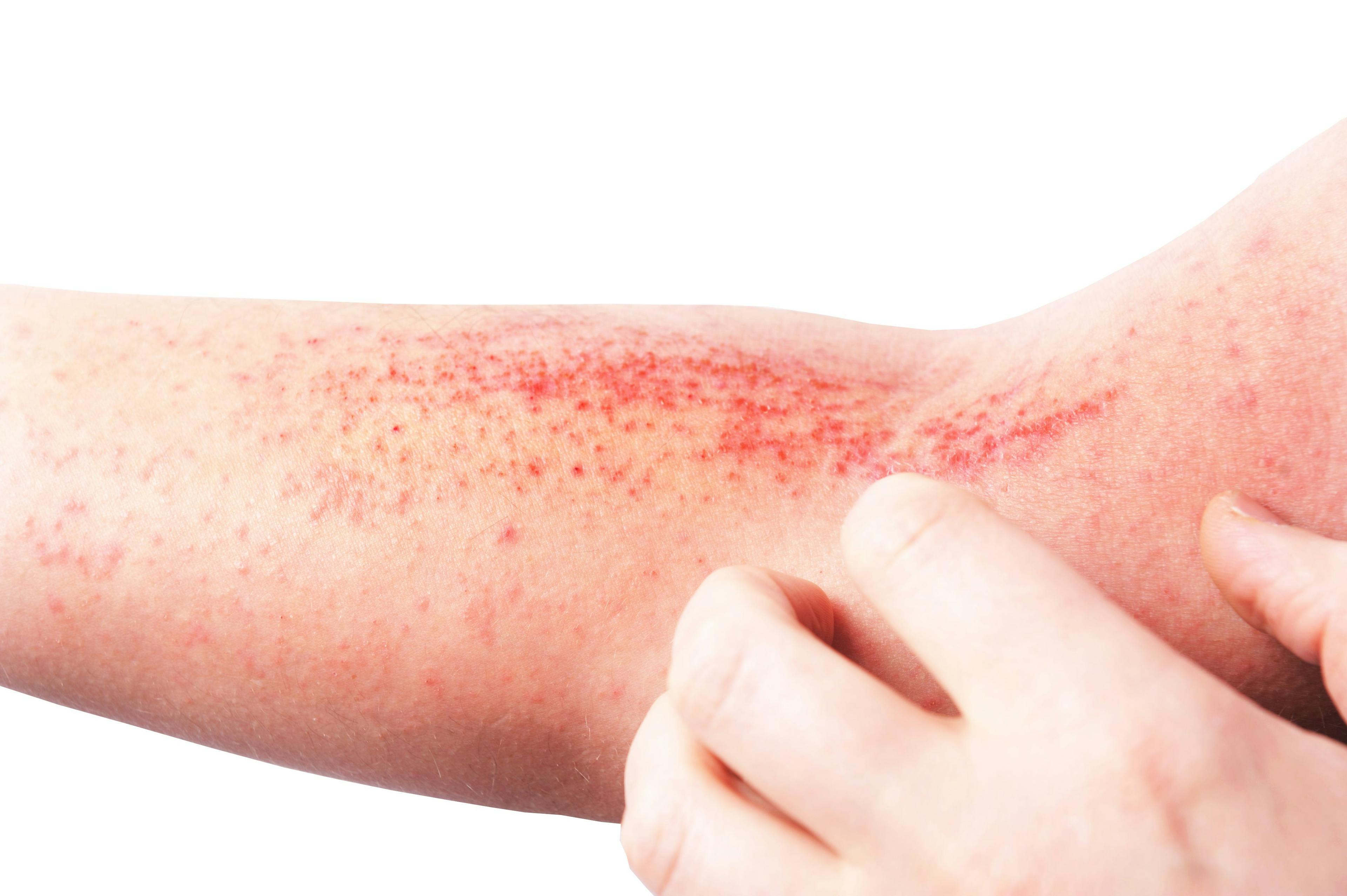 As-Needed Use of Opzelura Can Control Atopic Dermatitis 