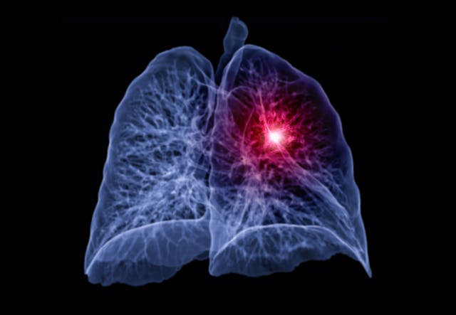 Immunotherapy vs. Chemotherapy as Second-line Treatment for NSCLC