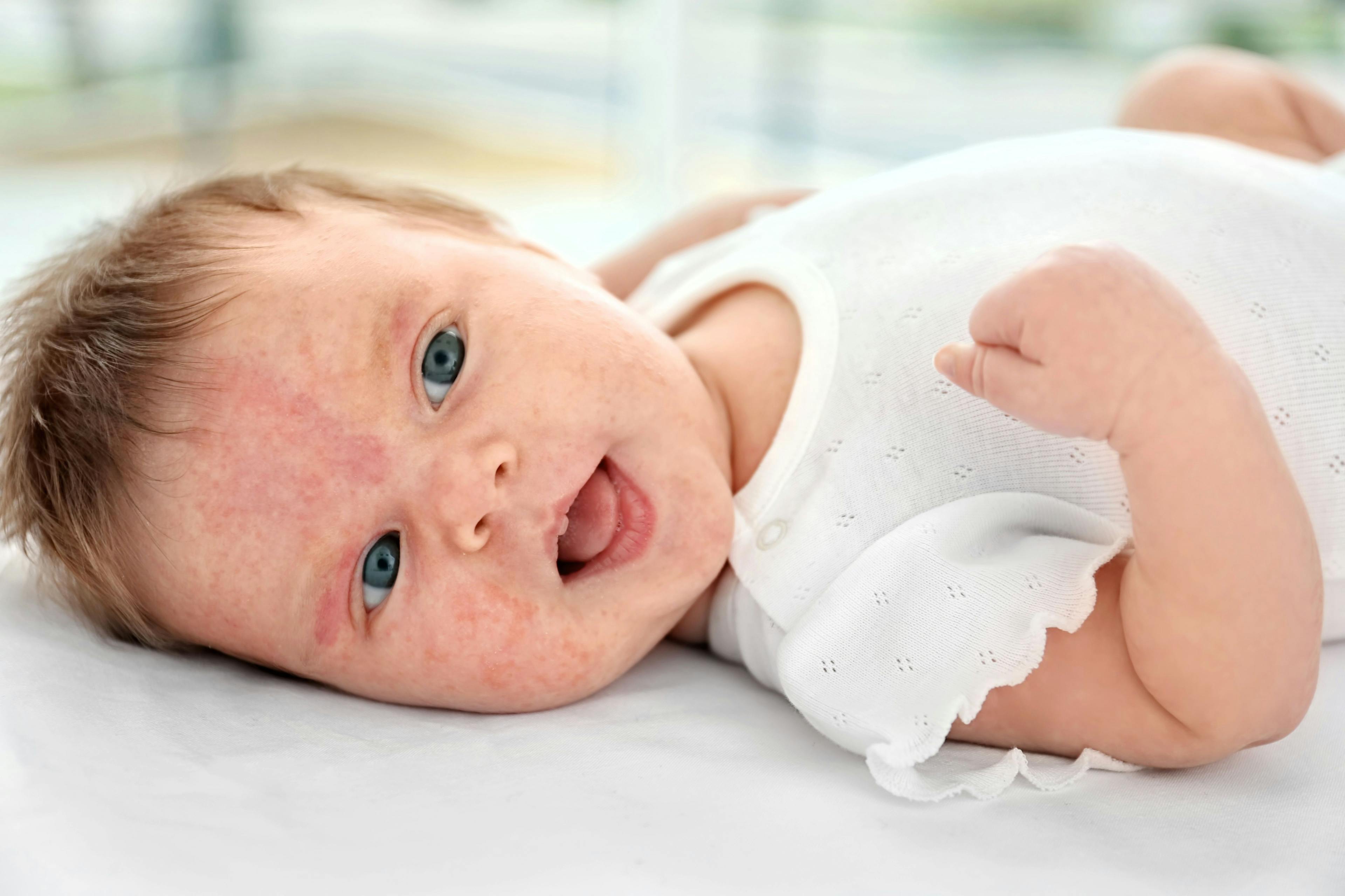 Non-invasive Test That May Help Predict Eczema in Babies