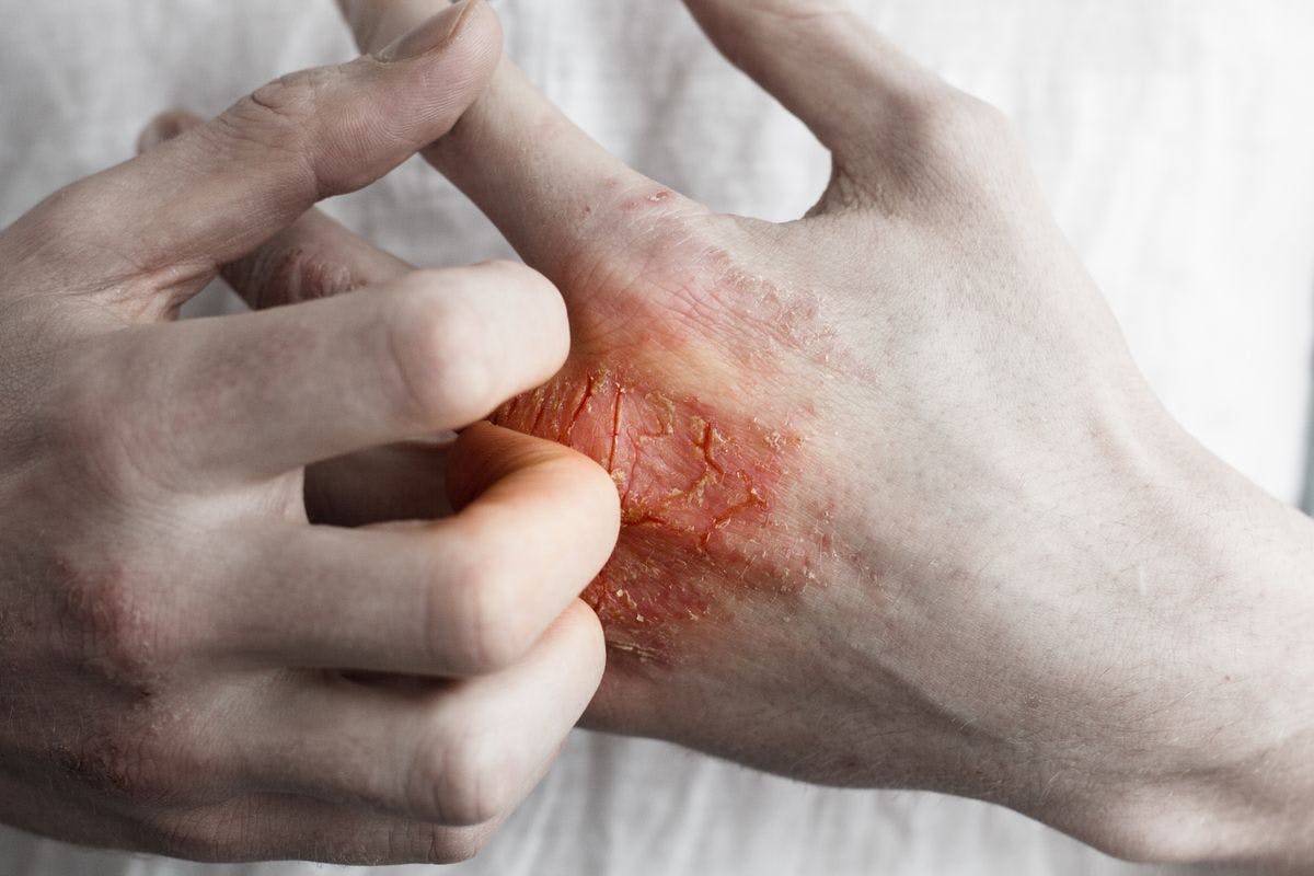 Patients with type 2 inflammation often experience frequent disease flare ups with intense itch, which impact quality of life.
