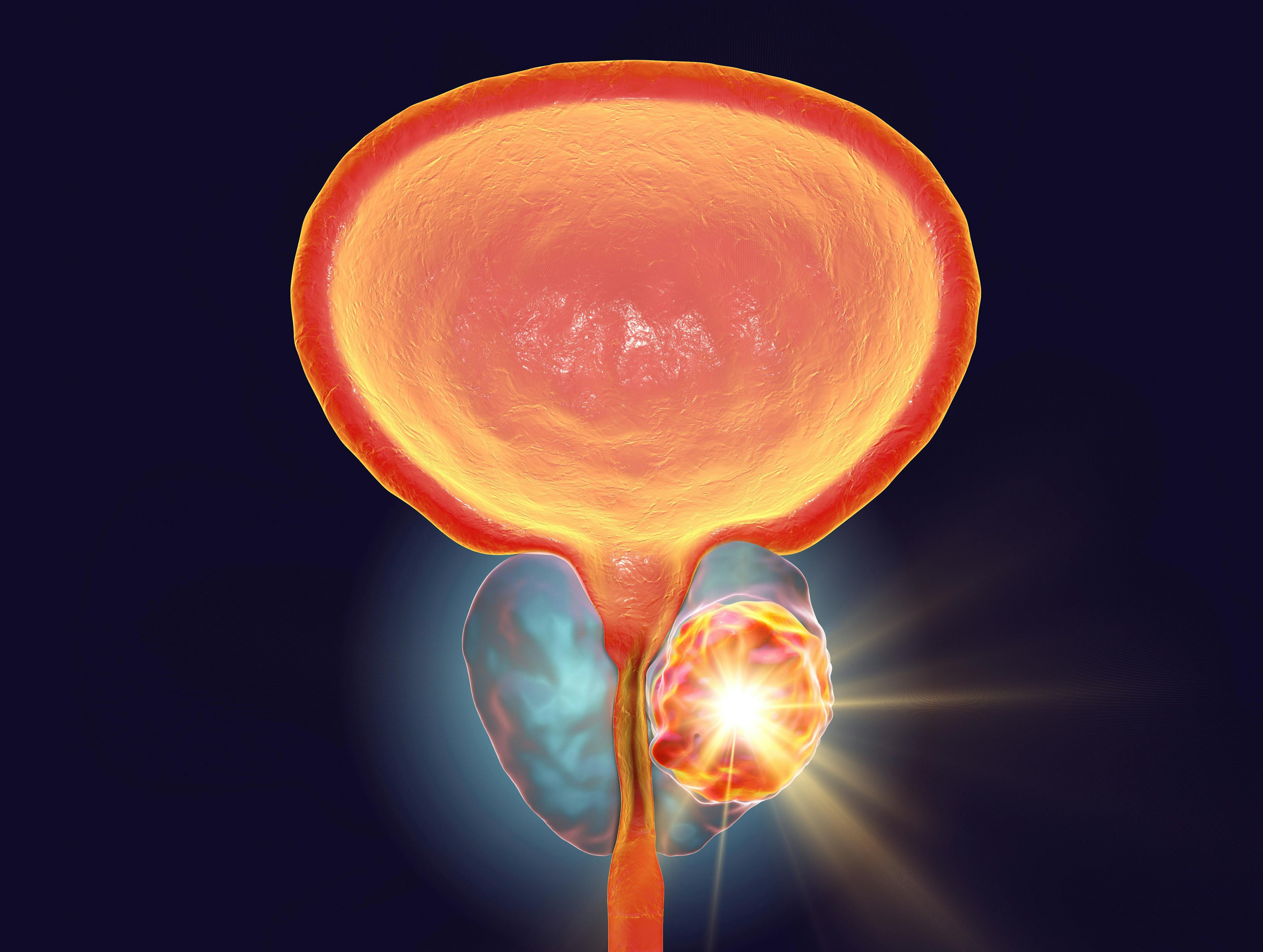 GLP-1 Agonists May One Day Treat Prostate Cancer