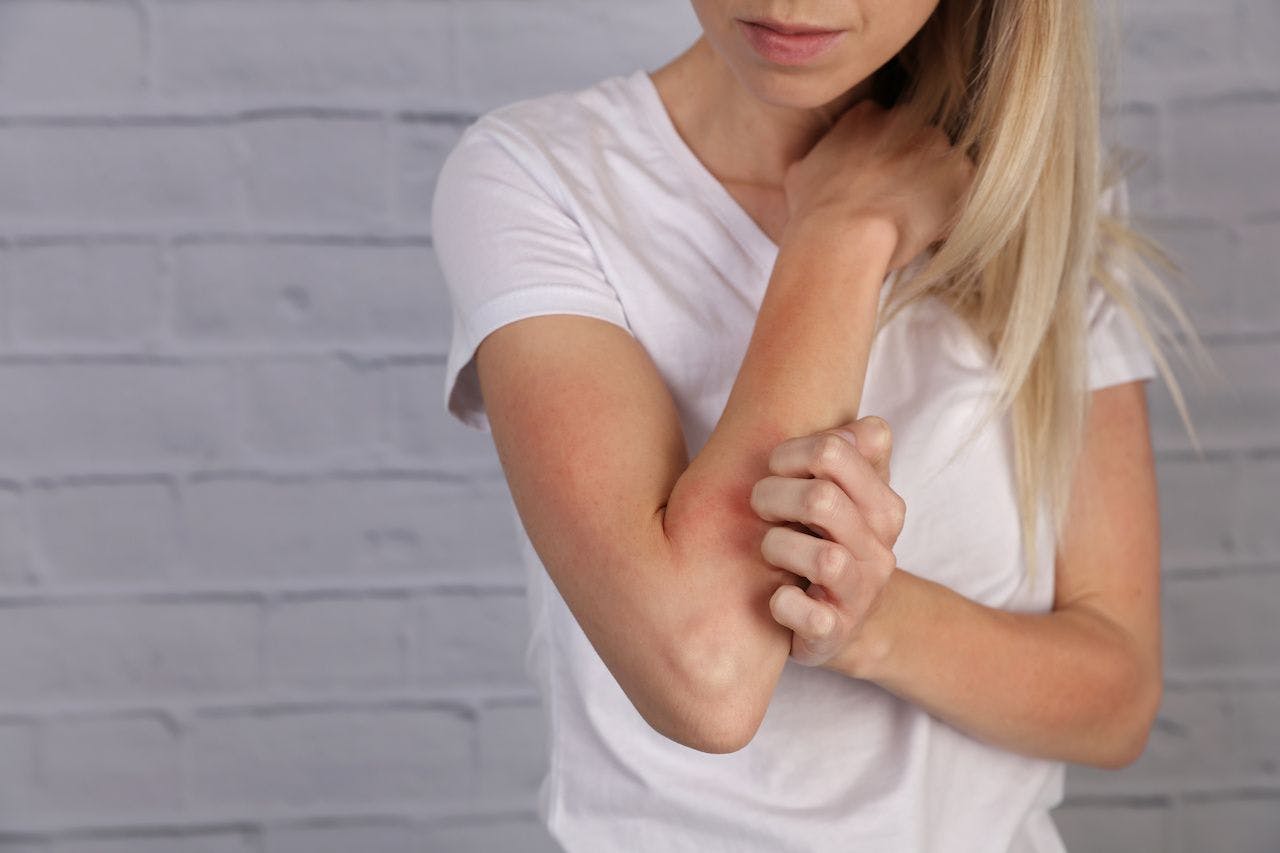 woman scratching arm | Image credit: dream@do - stock.adobe.com