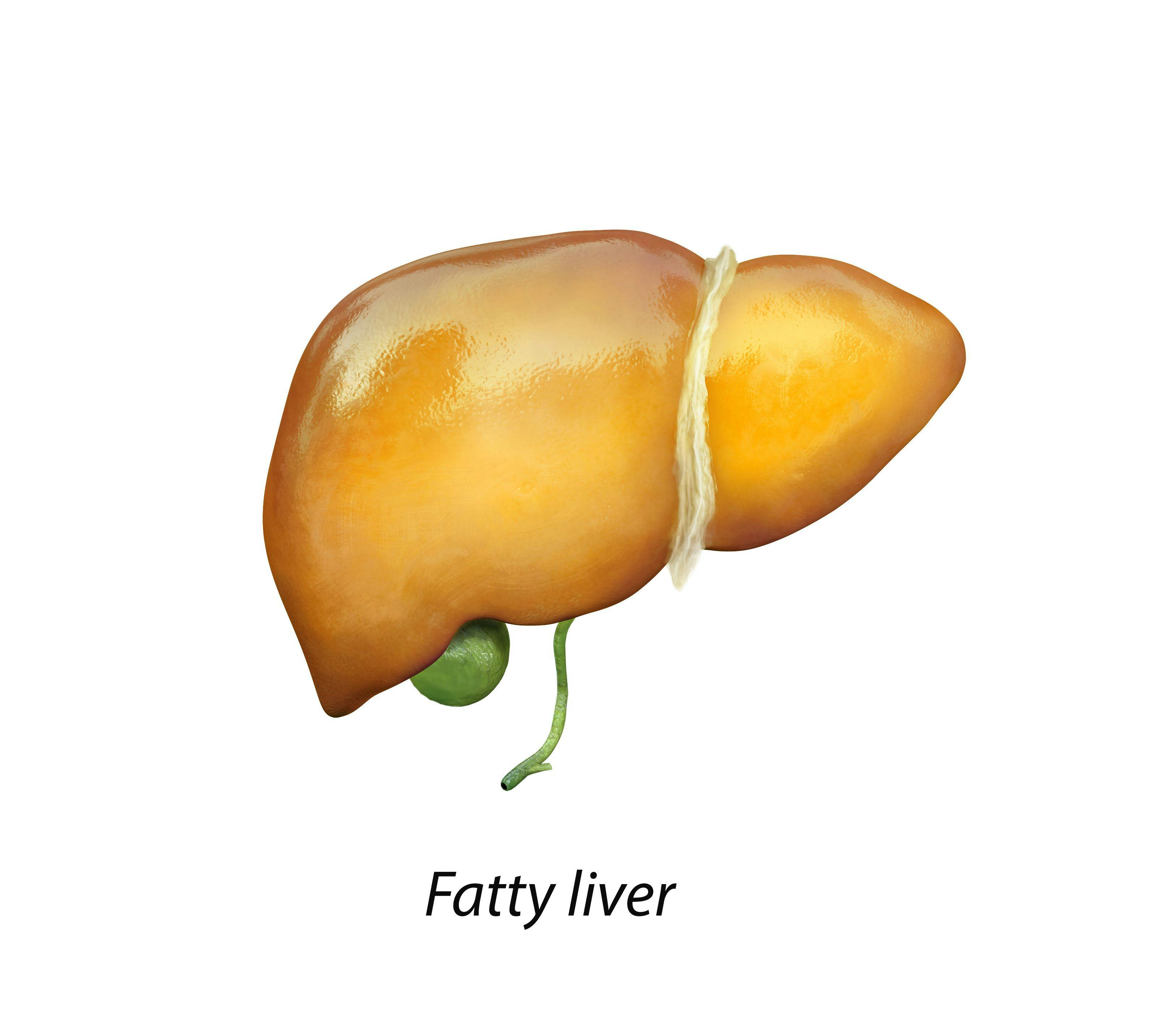 Positive Results for Resmetirom for Nonalcoholic Fatty Liver Disease