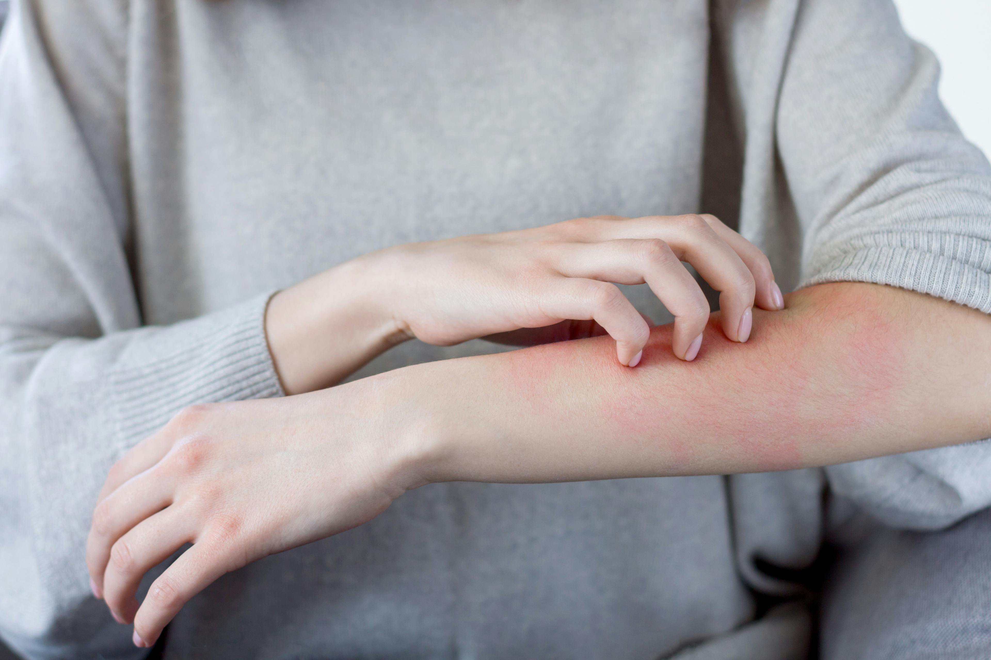 For Atopic Dermatitis Treatment, an Abundance of Options