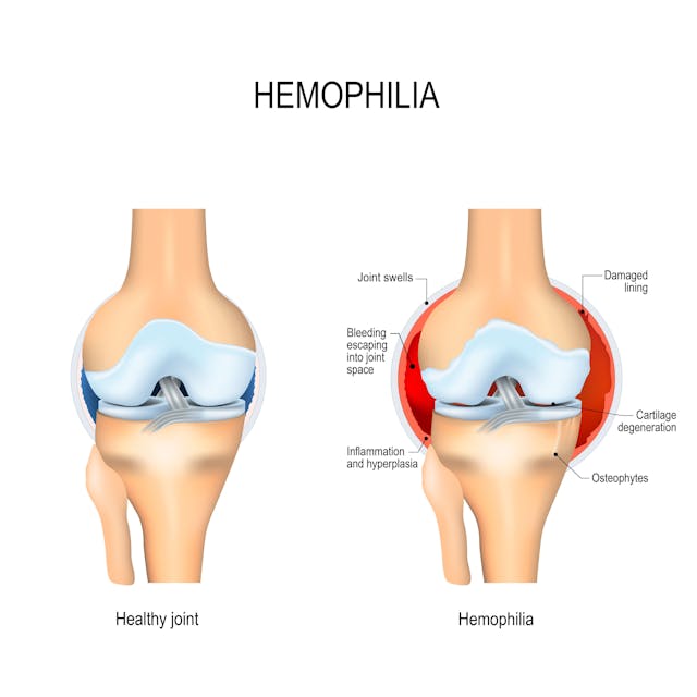 Study Highlights Poor Health Outcomes in Older Adults with Hemophilia