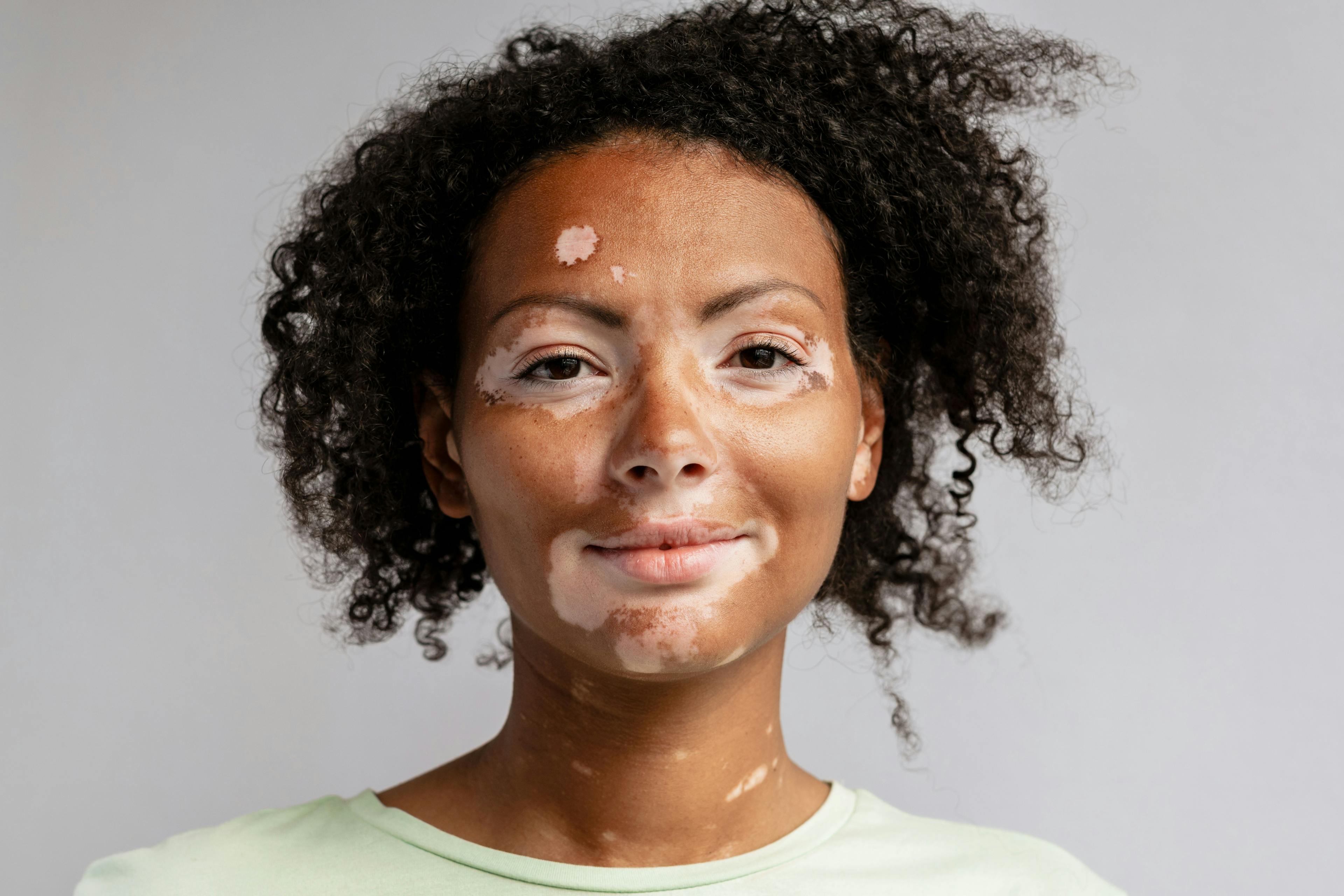 Microneedling Combined with Other Vitiligo Therapies Offers Promising Treatment for Skin Disease