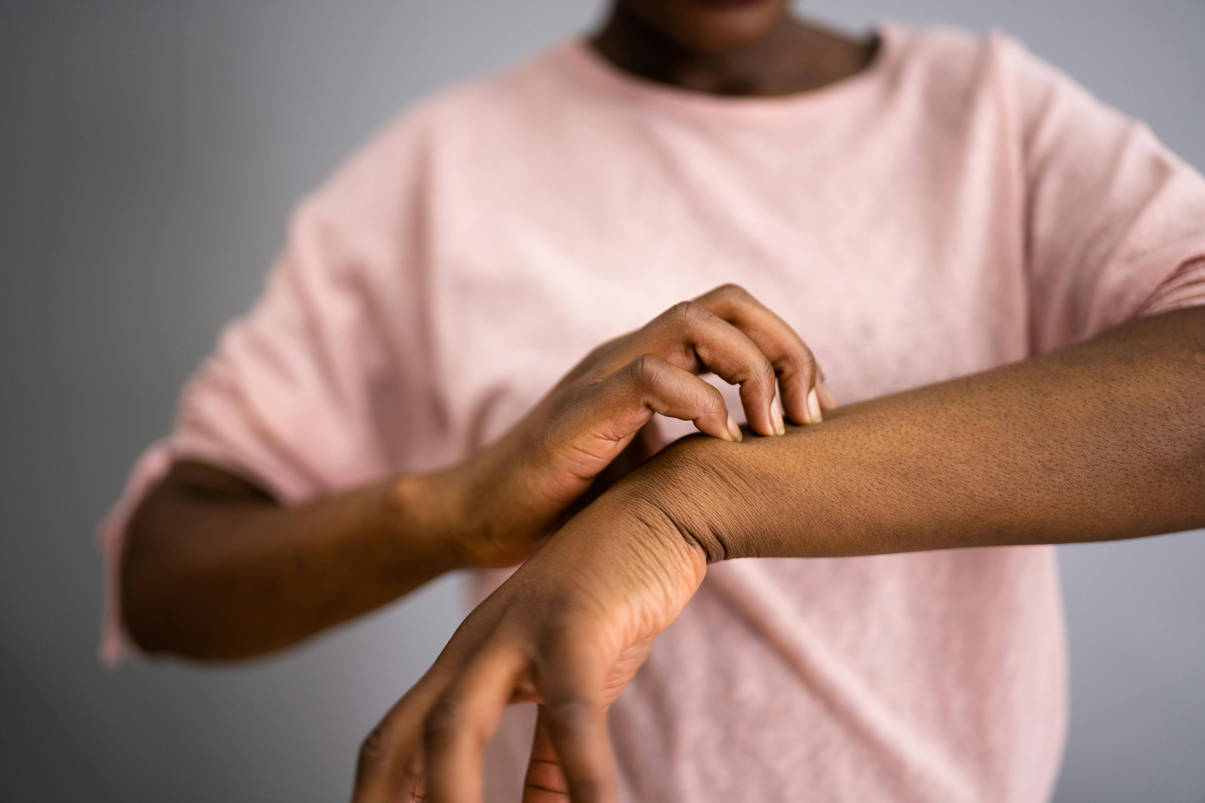   In Type 2 Inflammation, an Unexpected Relationship Between Itchiness and Inflammation