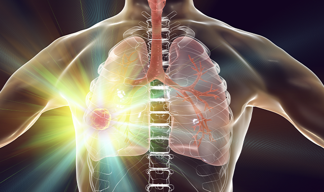 Lung Cancer Treatment: Bespoke and Guided by Biomarkers 