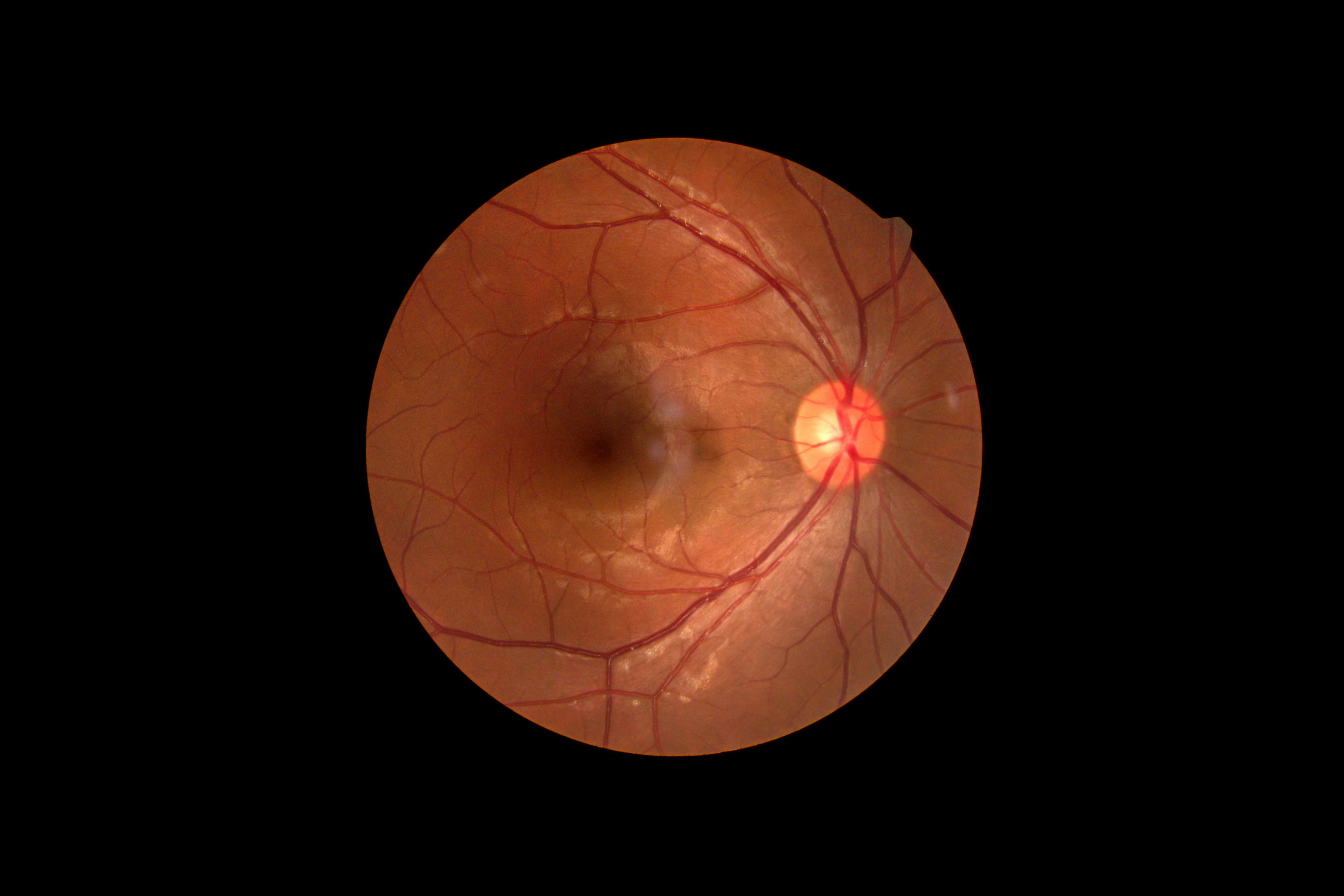 Risk of Retinal Vascular Occlusion After COVID-19 Vaccination