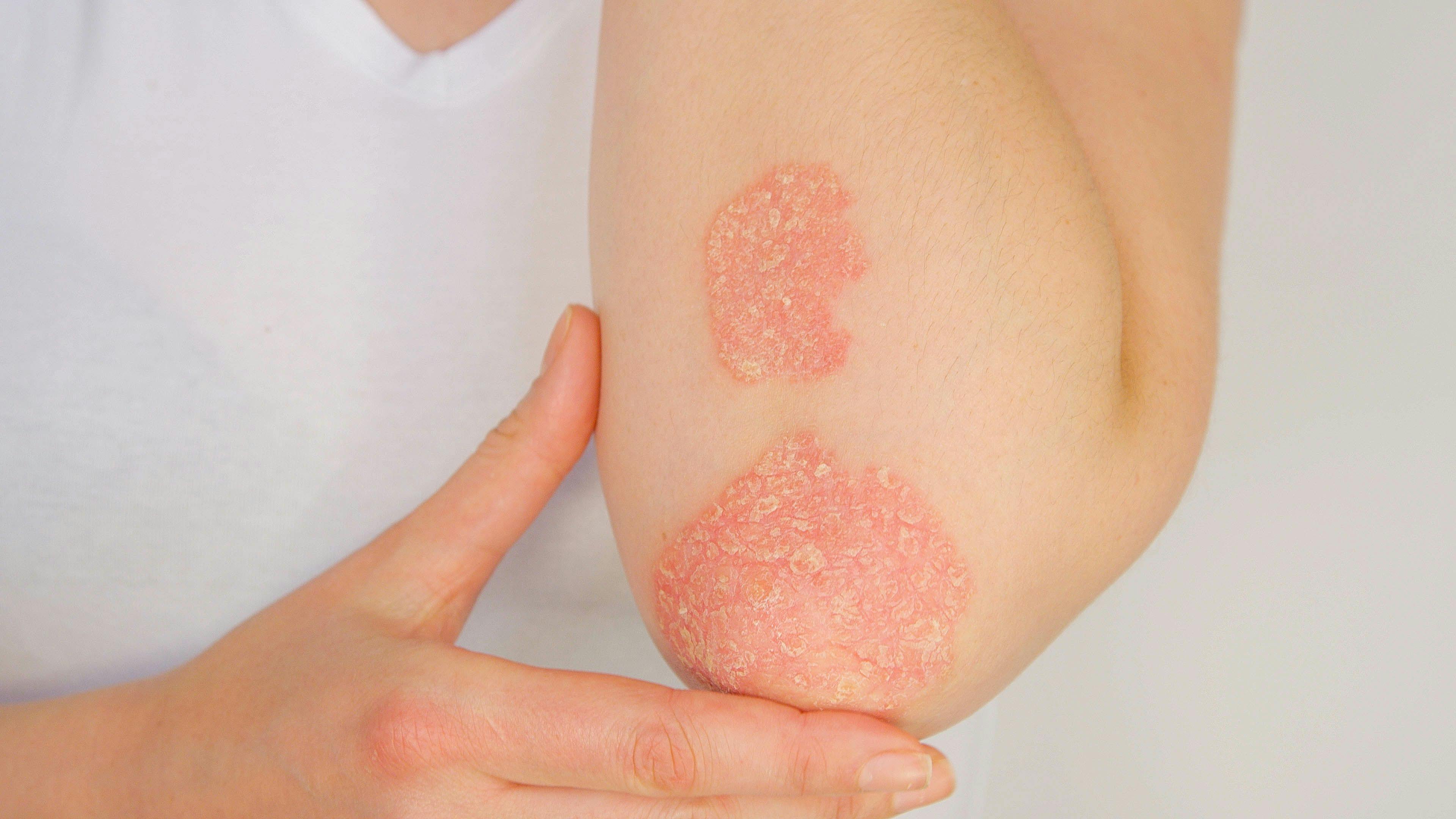 Severity of Skin Symptoms Key Factor in the Quality of Life of People with Psoriatic Arthritis