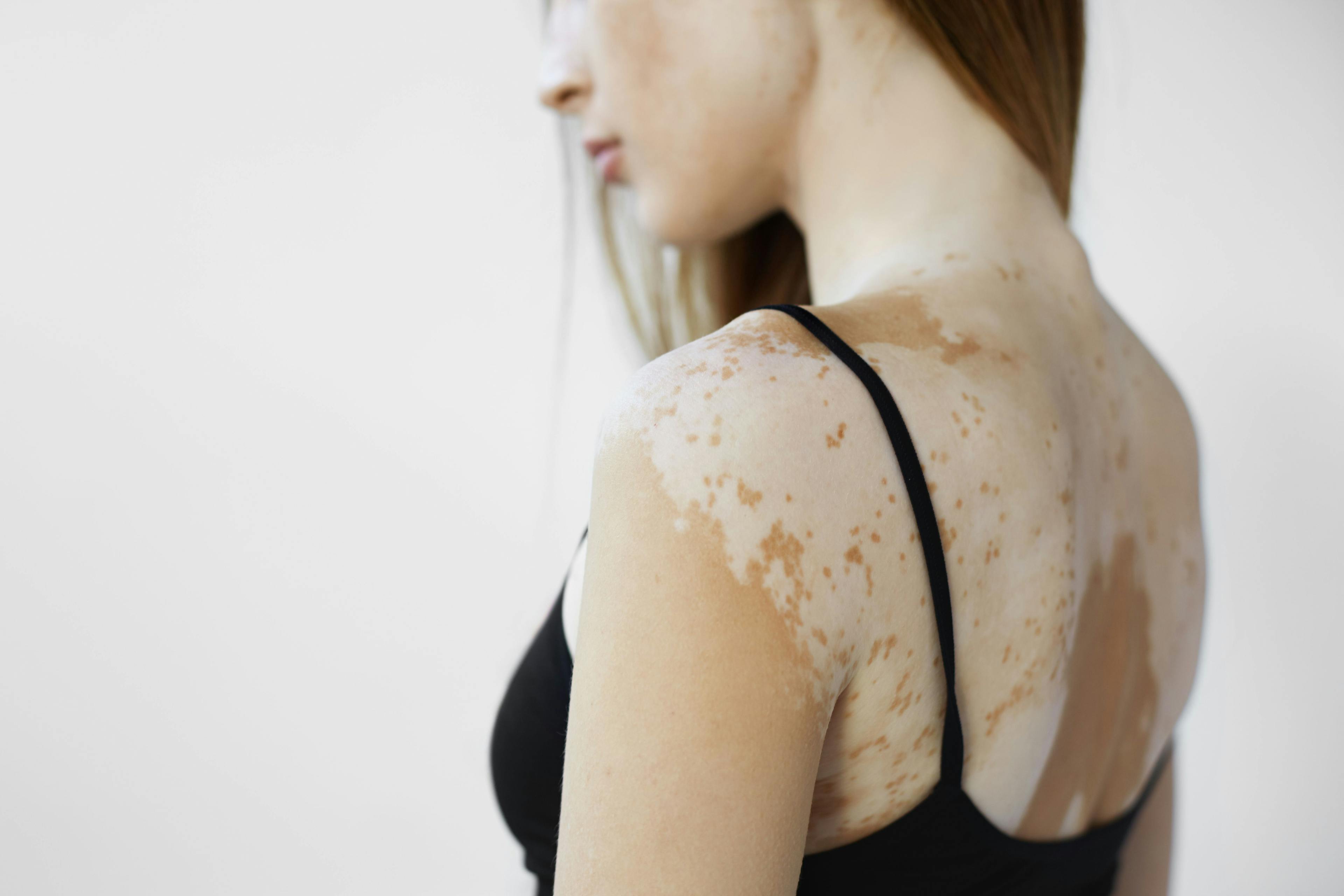 Studies Find High Prevalence of Suicidal Ideation in Patients with Vitiligo