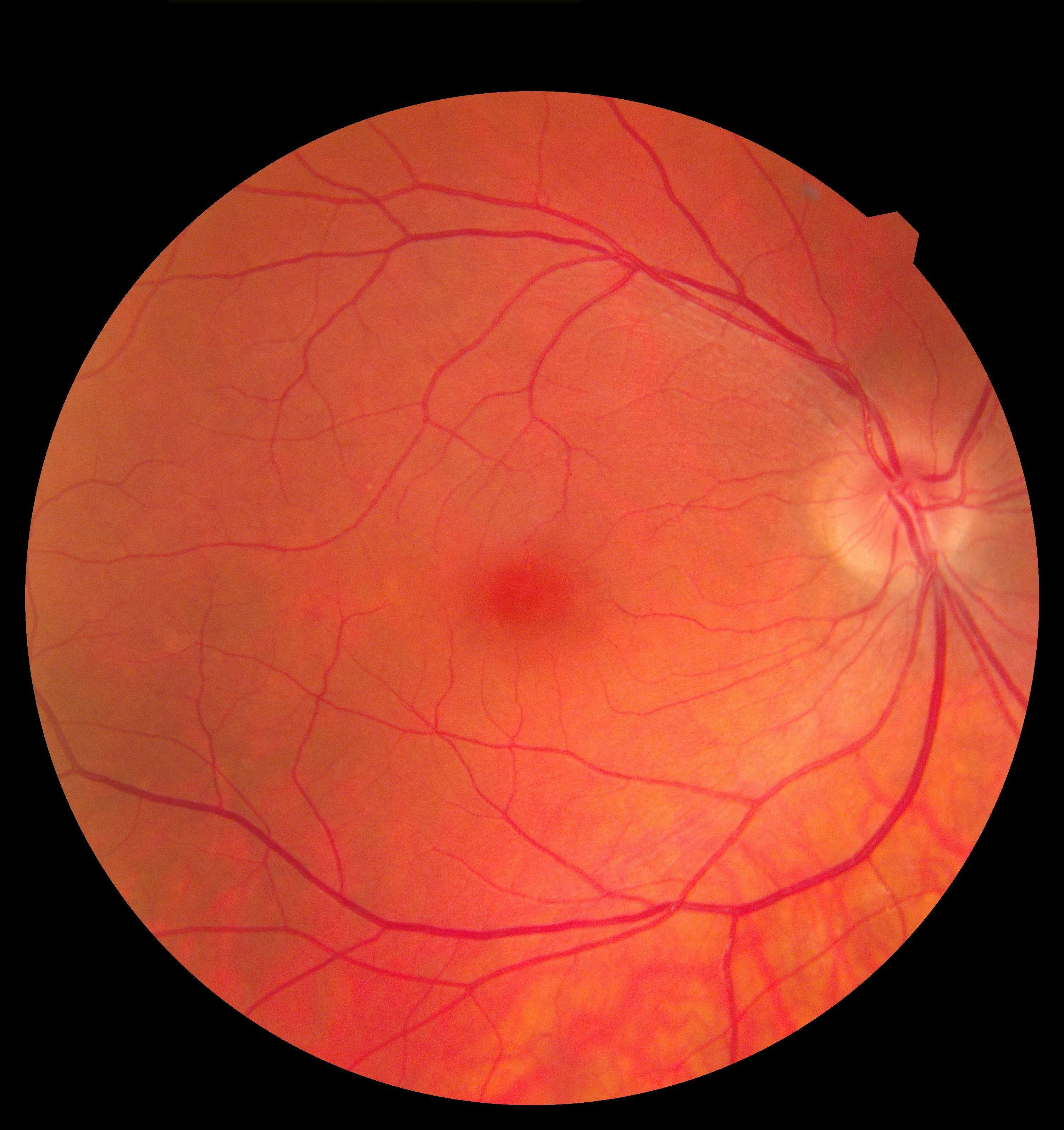 New Study Shows Extended-Dose EYLEA HD is Effective for wAMD and DME