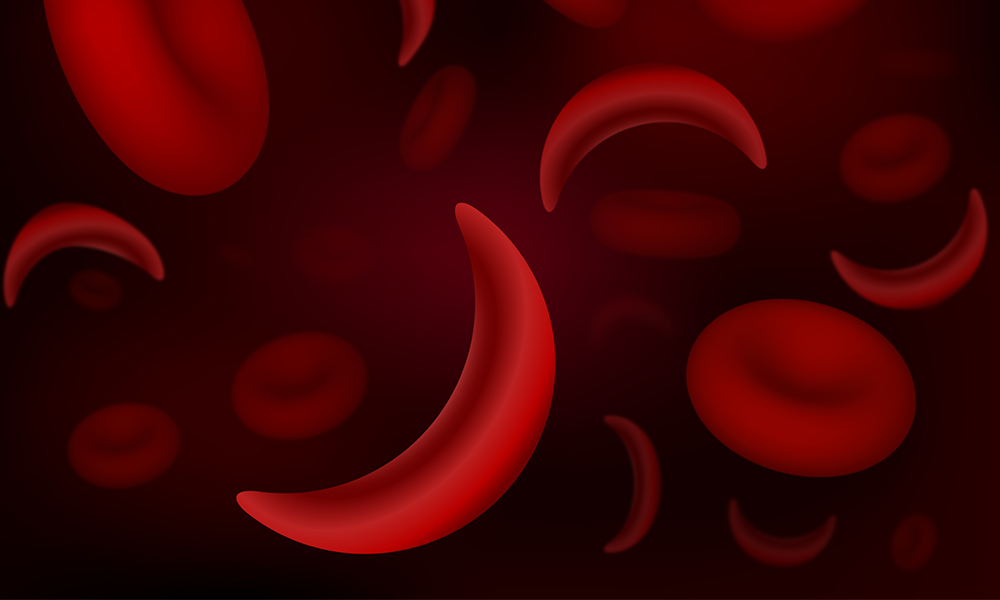 Sickle Cell Disease Finally Getting its Due