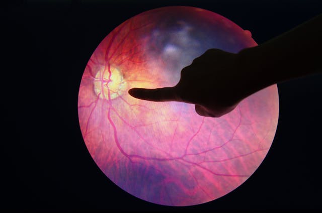 Female Carriers of X-Linked Retinal Diseases Advocate for Gene Therapy Access