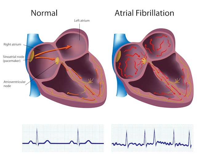 Right Atrial Enlargement Is Linked to Outcomes in Atrial Fibrillation