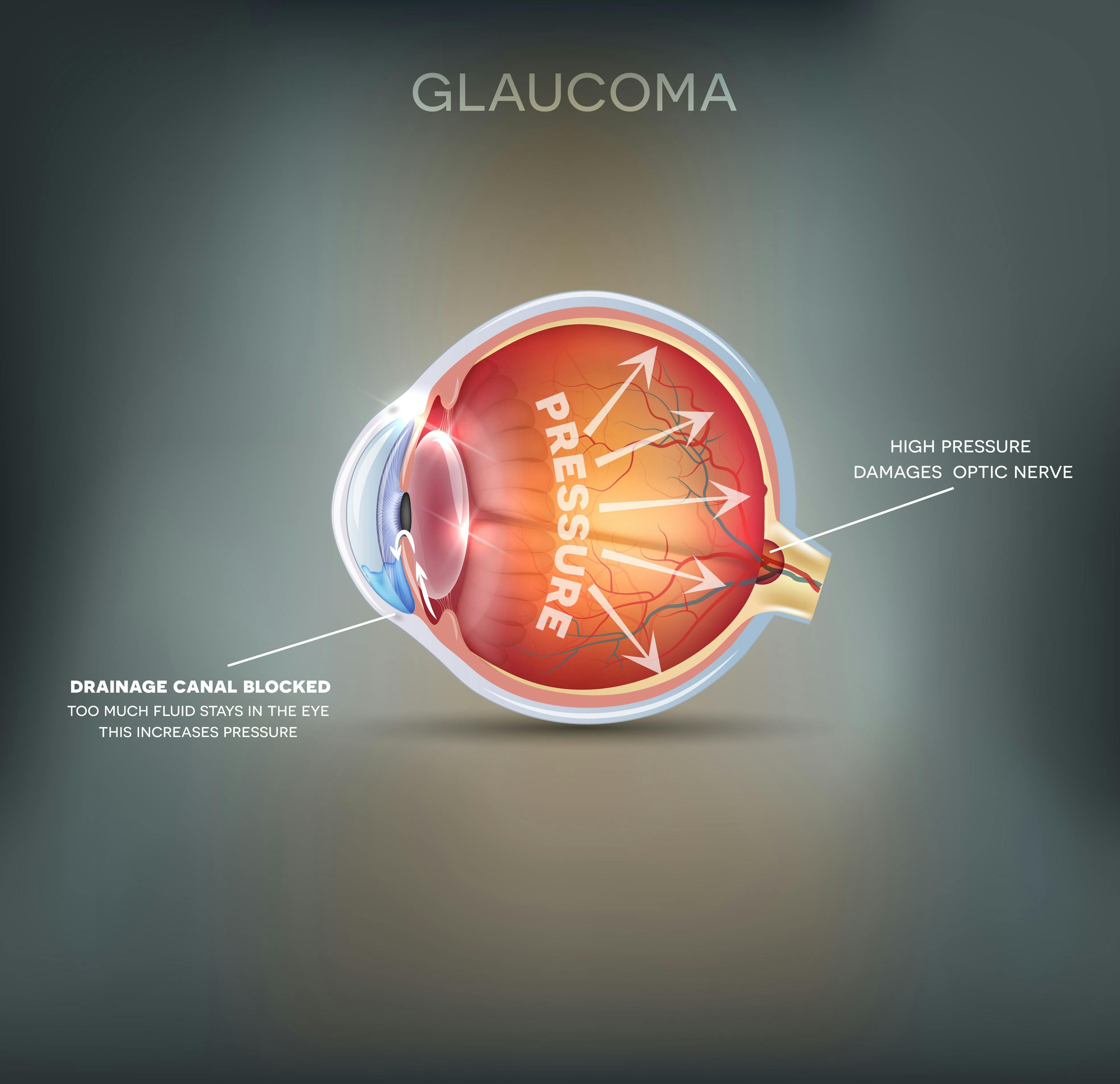 Glaucoma is Undertreated Among Minorities | AAO 2023