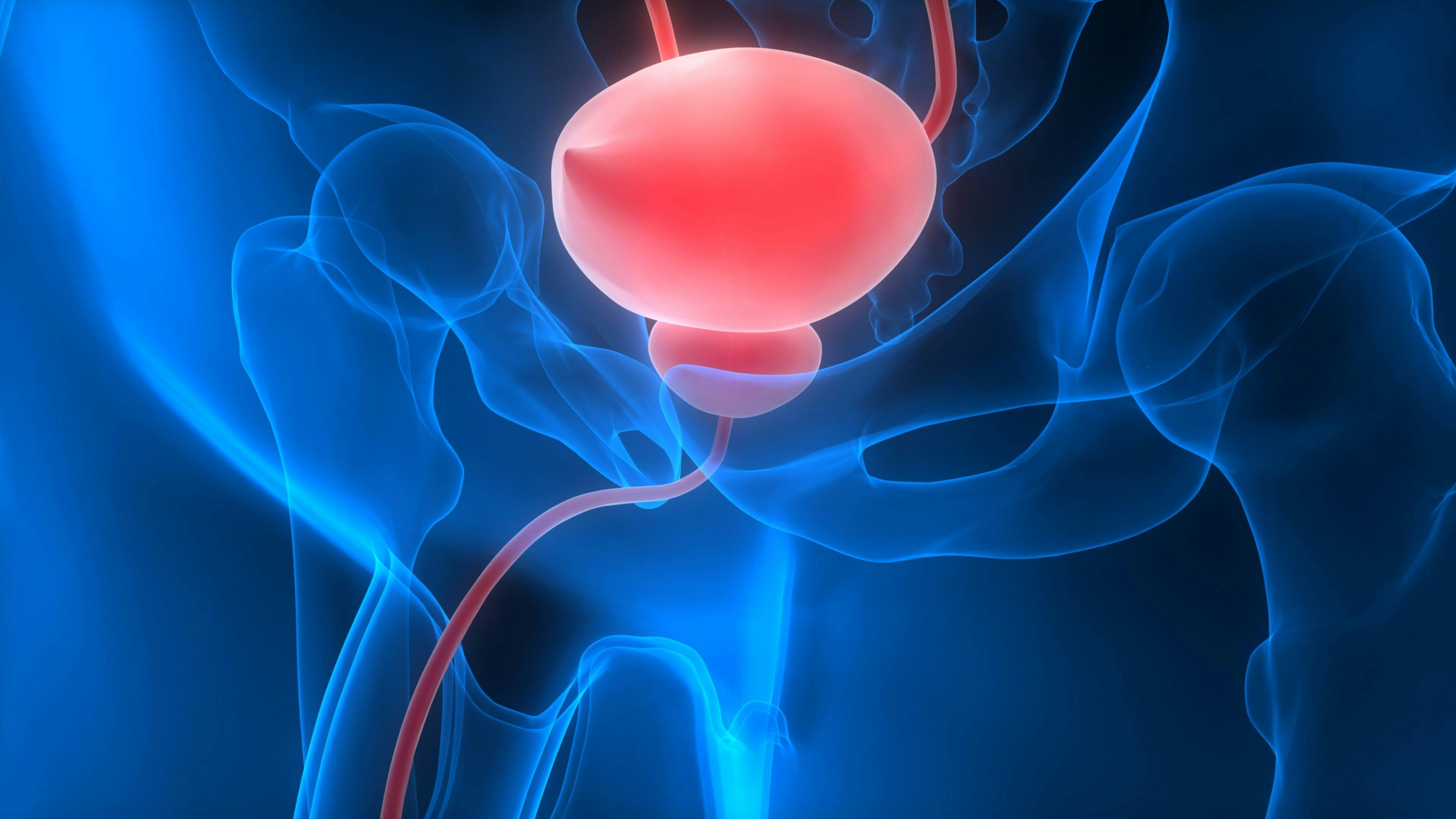 Research Shines Light on  Bladder-Sparing Treatment of Muscle-invasive Bladder Cancer
