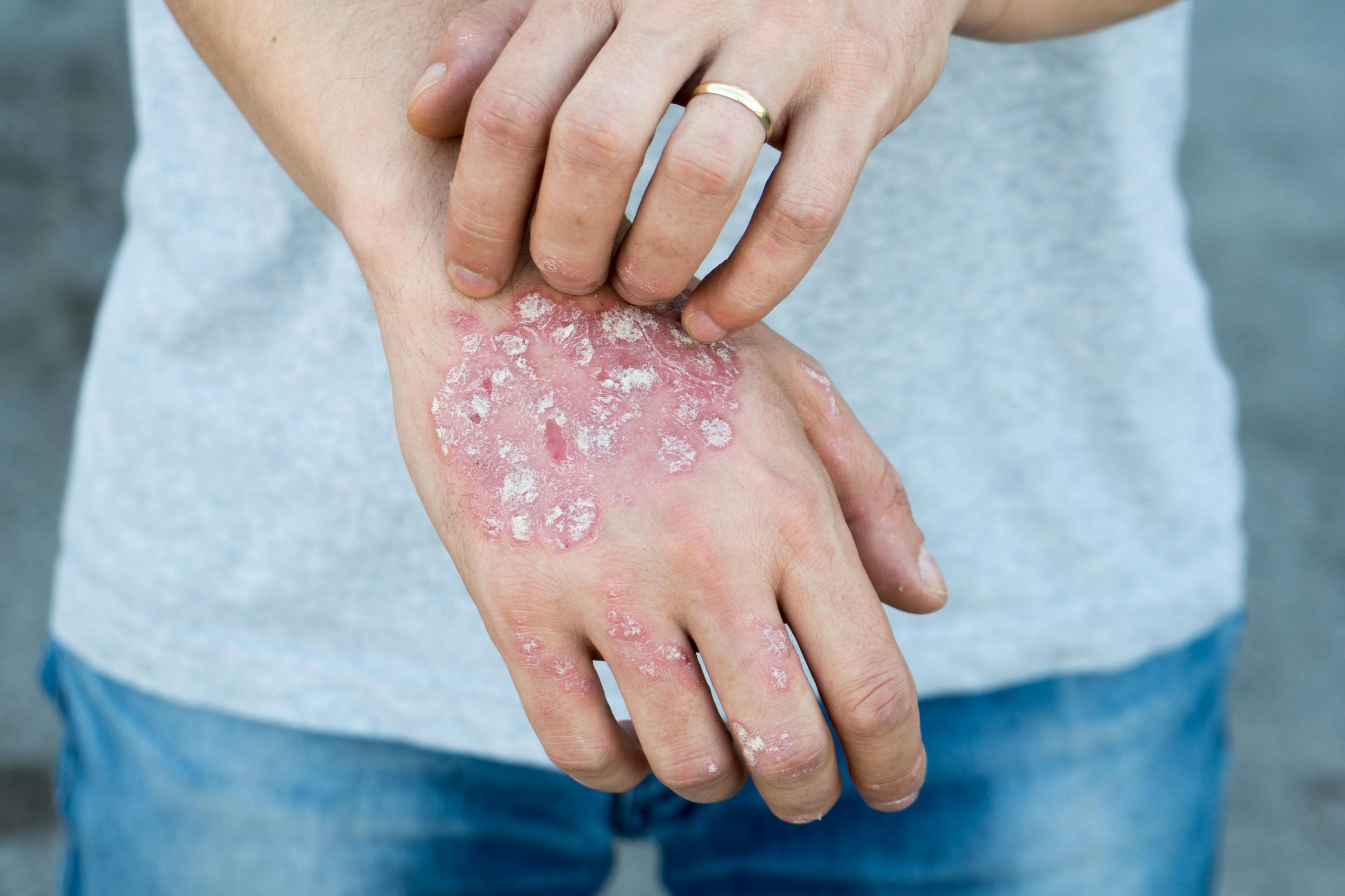 Newest Psoriasis Treatment is Now Available