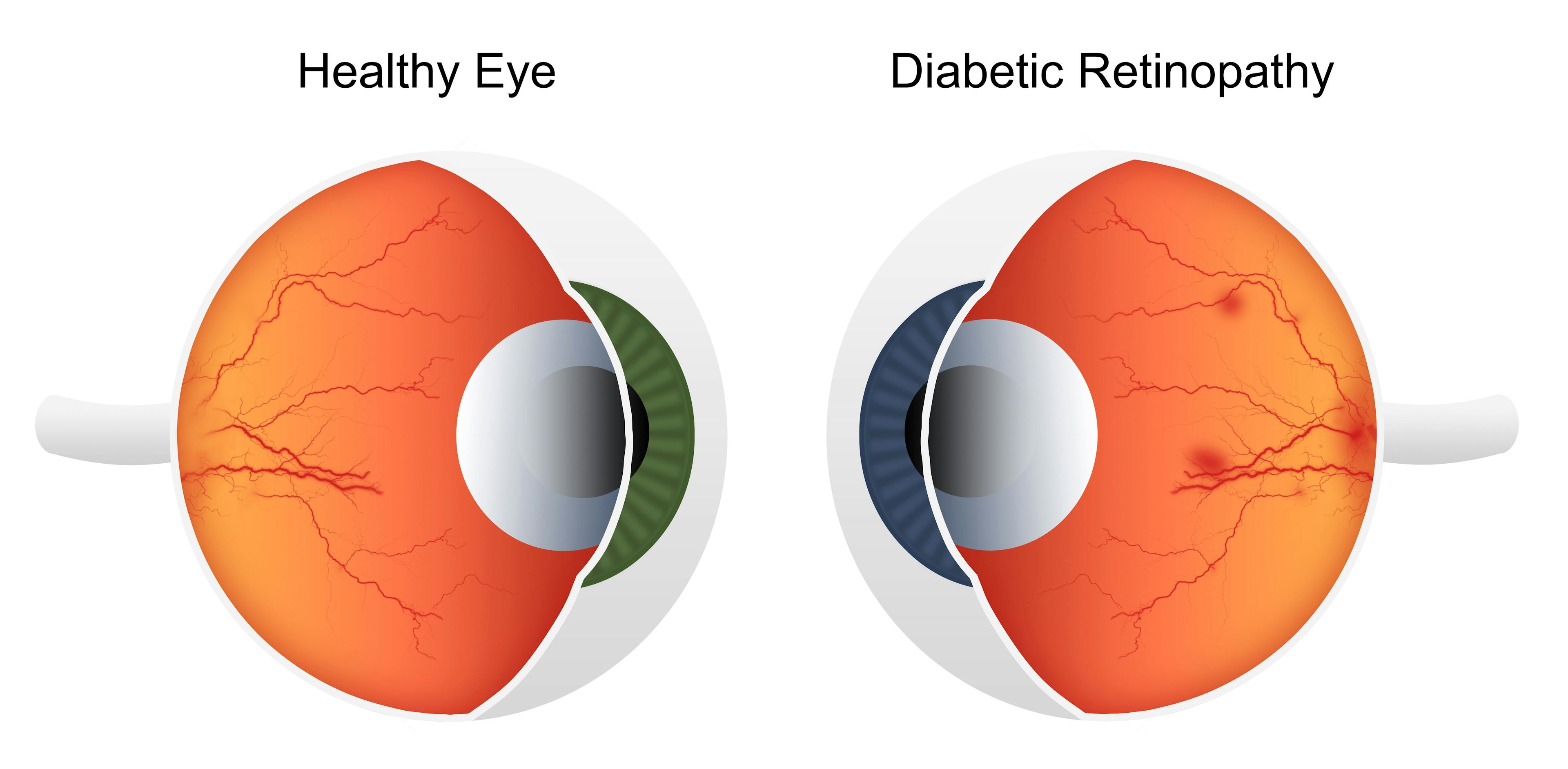 1 in 4 Patients With Diabetes Have Diabetic Retinopathy, Study Funds