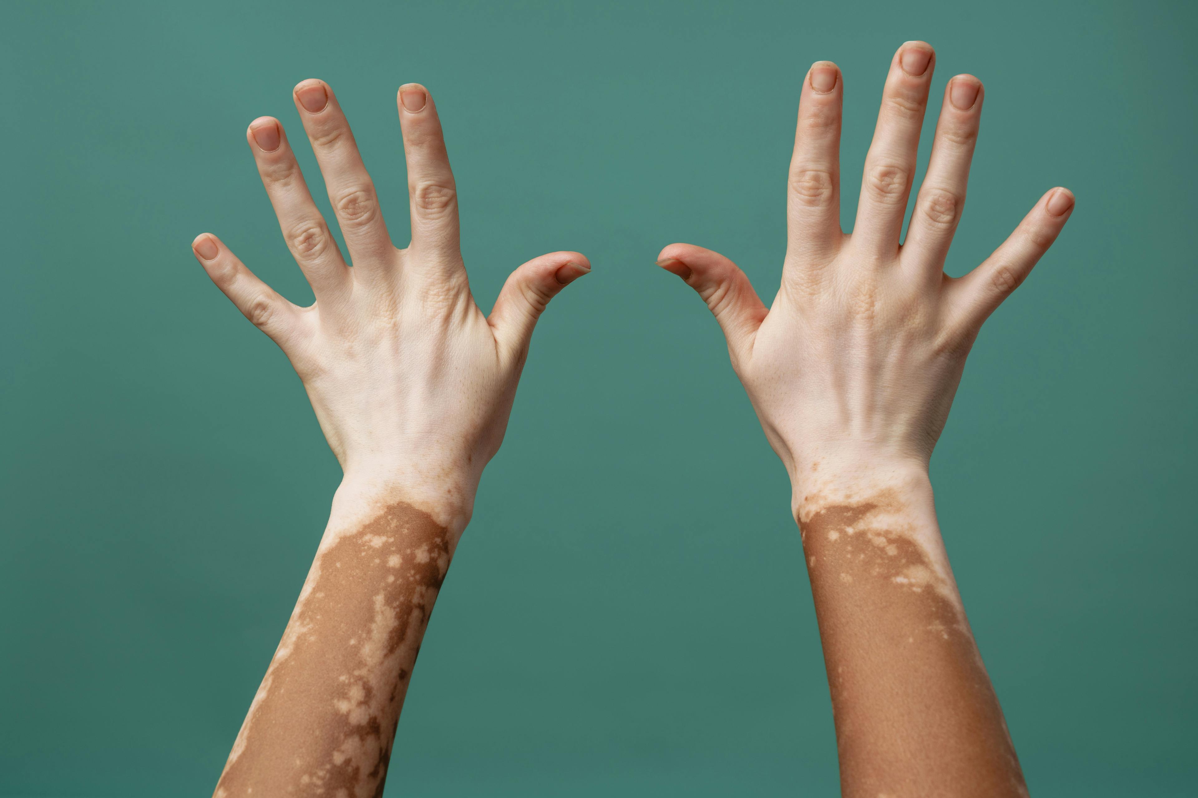 Researchers have discovered genes tied to melanin production, which could lead to new drugs for vitiligo and other pigmentation diseases. (Image credit: ©Drobot Dean - stock.adobe.com)