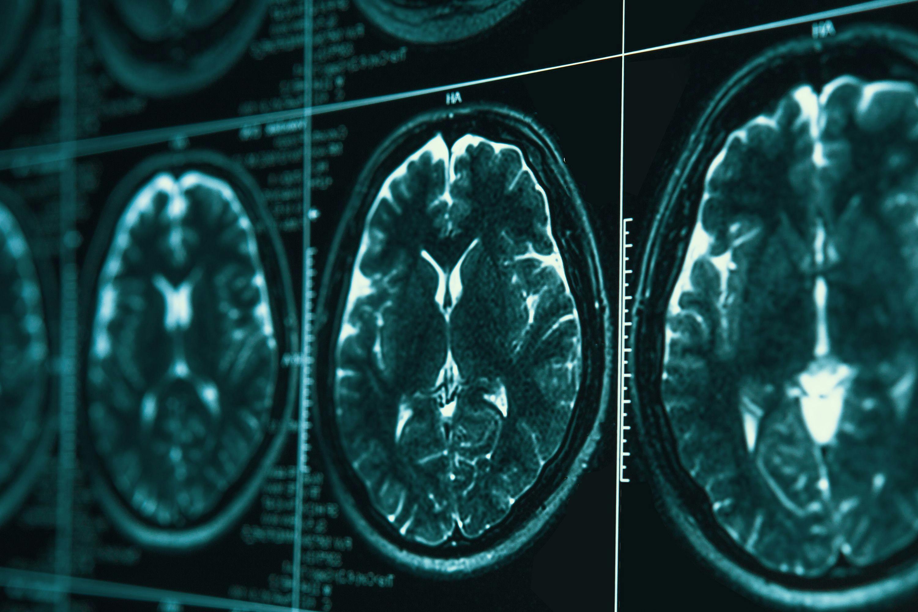 Researchers: Use of Contrast Agent in Follow-up MRIs of MS Patients Can Be Minimized