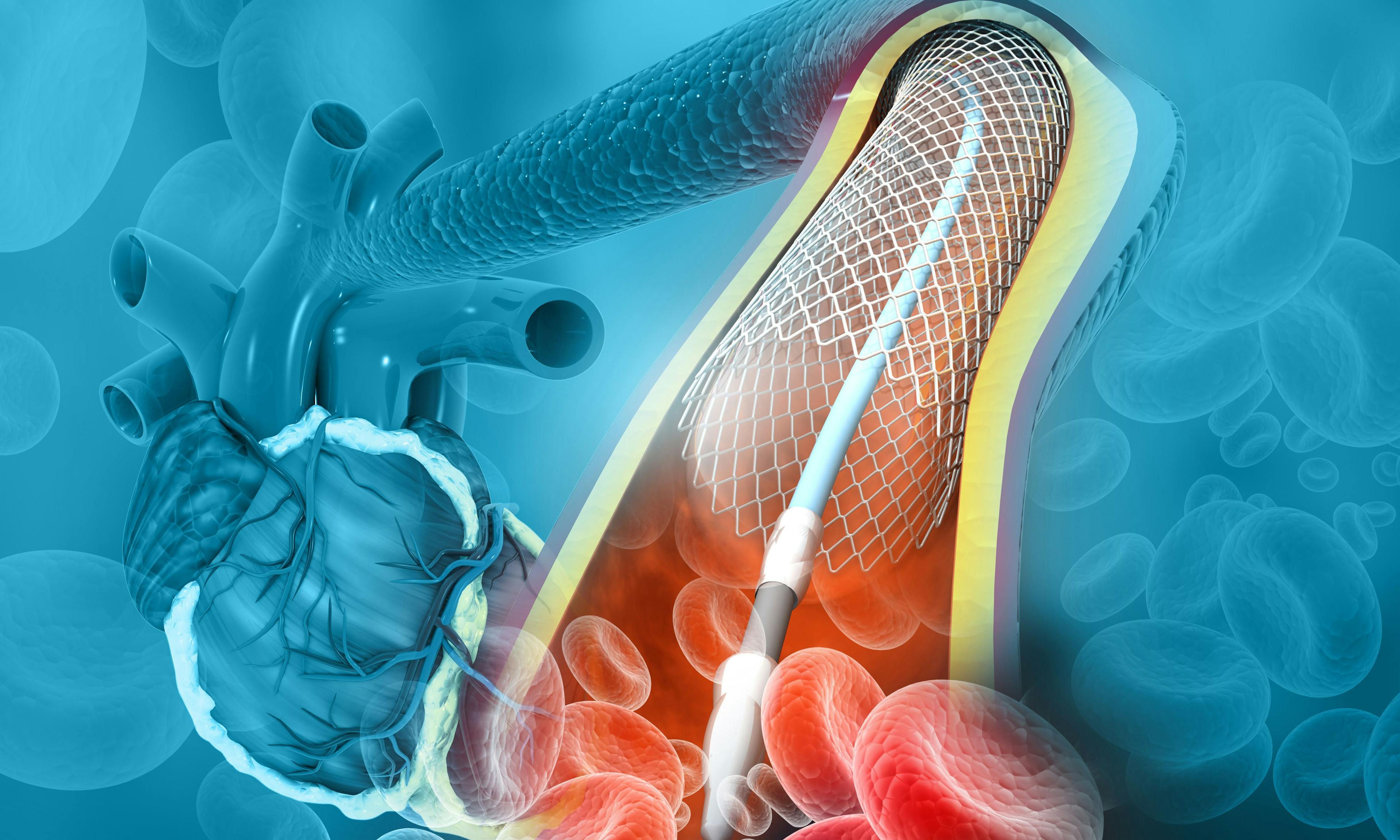Angioplasty For Stable Angina On Par With Antianginal Medications, Say ORBITA-2 Investigators | AHA Scientific Sessions
