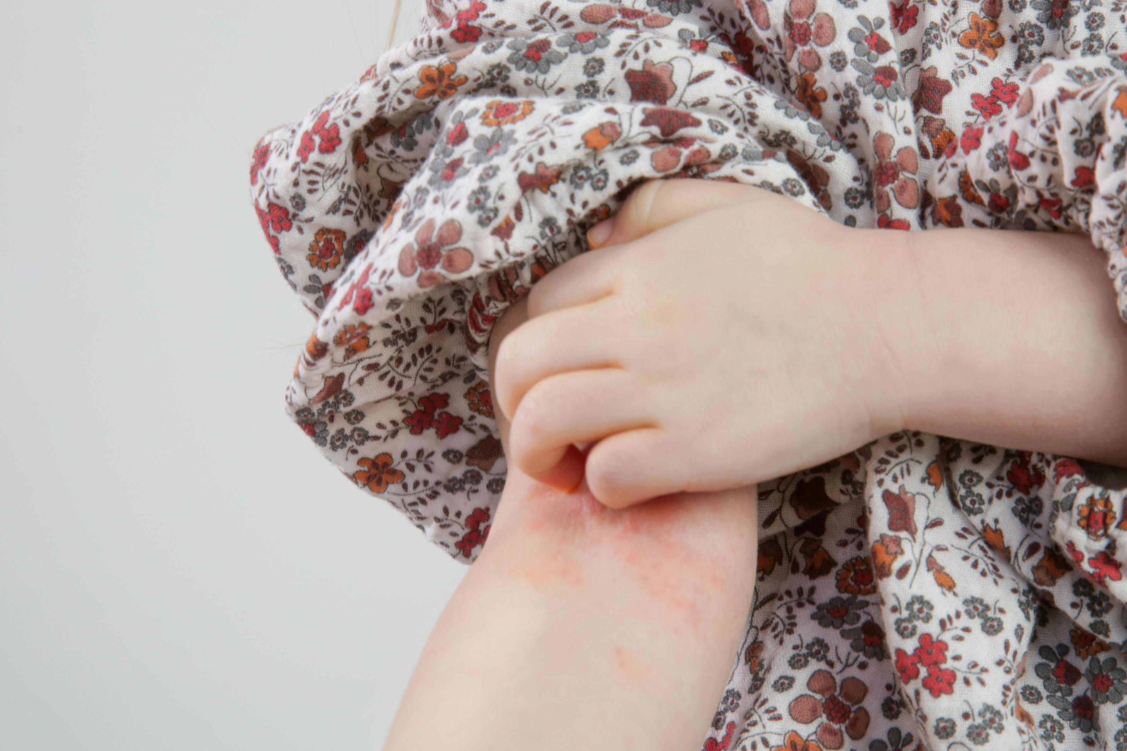 Atopic Dermatitis and Allergic Contact Dermatitis Overlap in Children. Why Patch Testing to Tell Them Apart Is Important