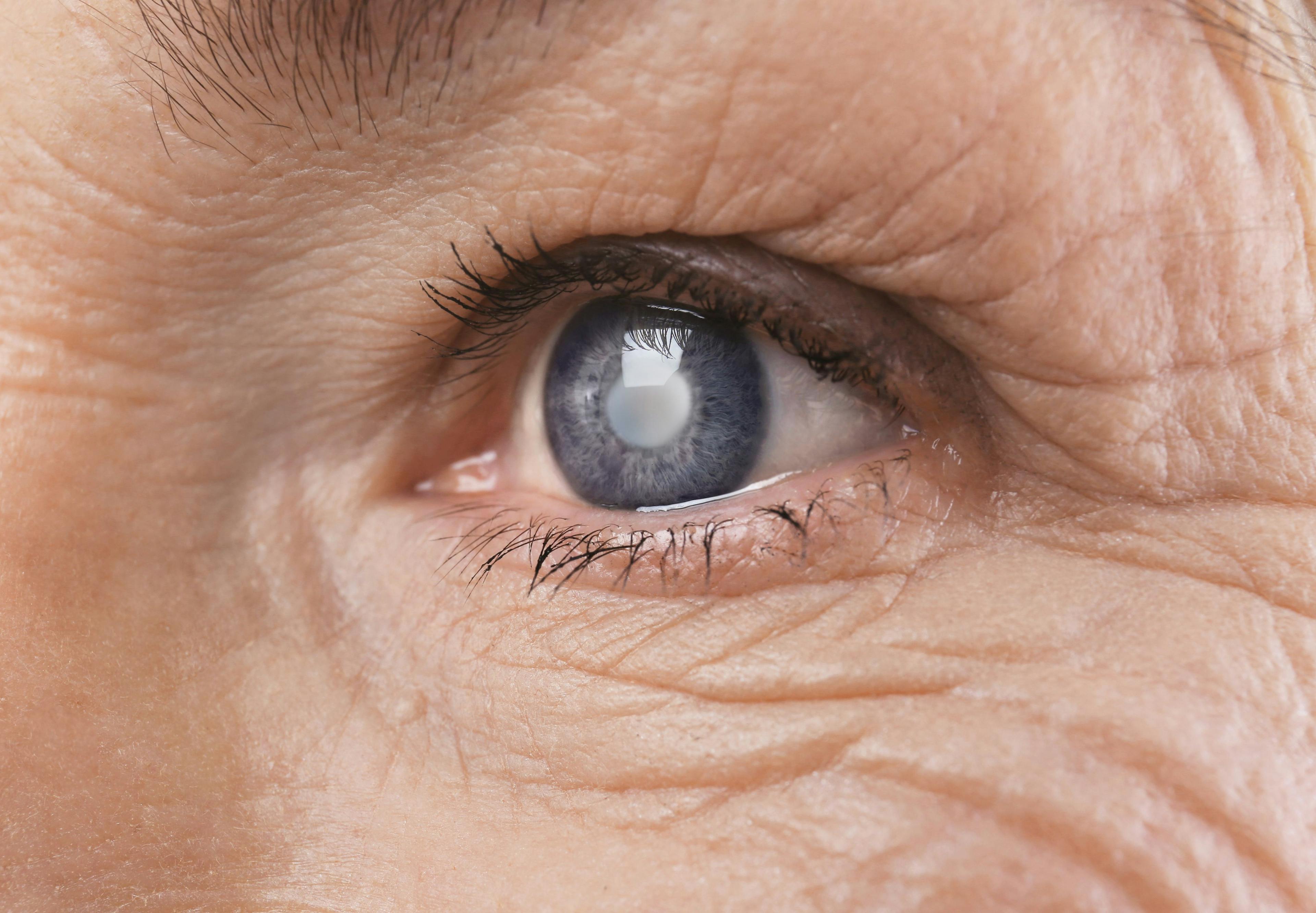 Cholesterol-Lowering Gene May Increase Risk of Cataracts