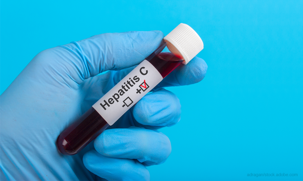 Hepatitis C blood sample
