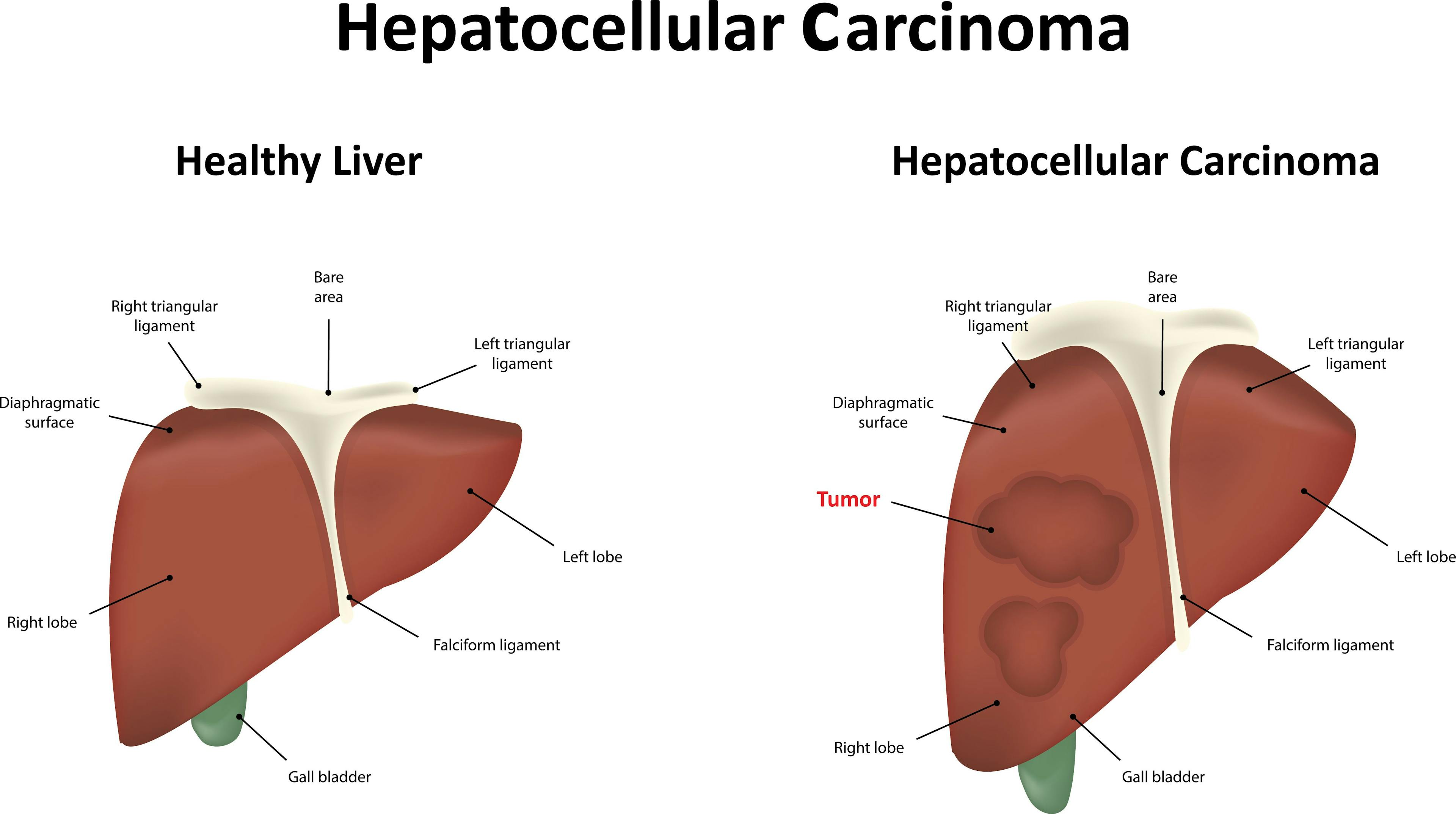 Antivirals After Liver Resection for HBV-Associated Hepatocellular Carcinoma: Which Is Better, Tenofovir vs. Entecavir?