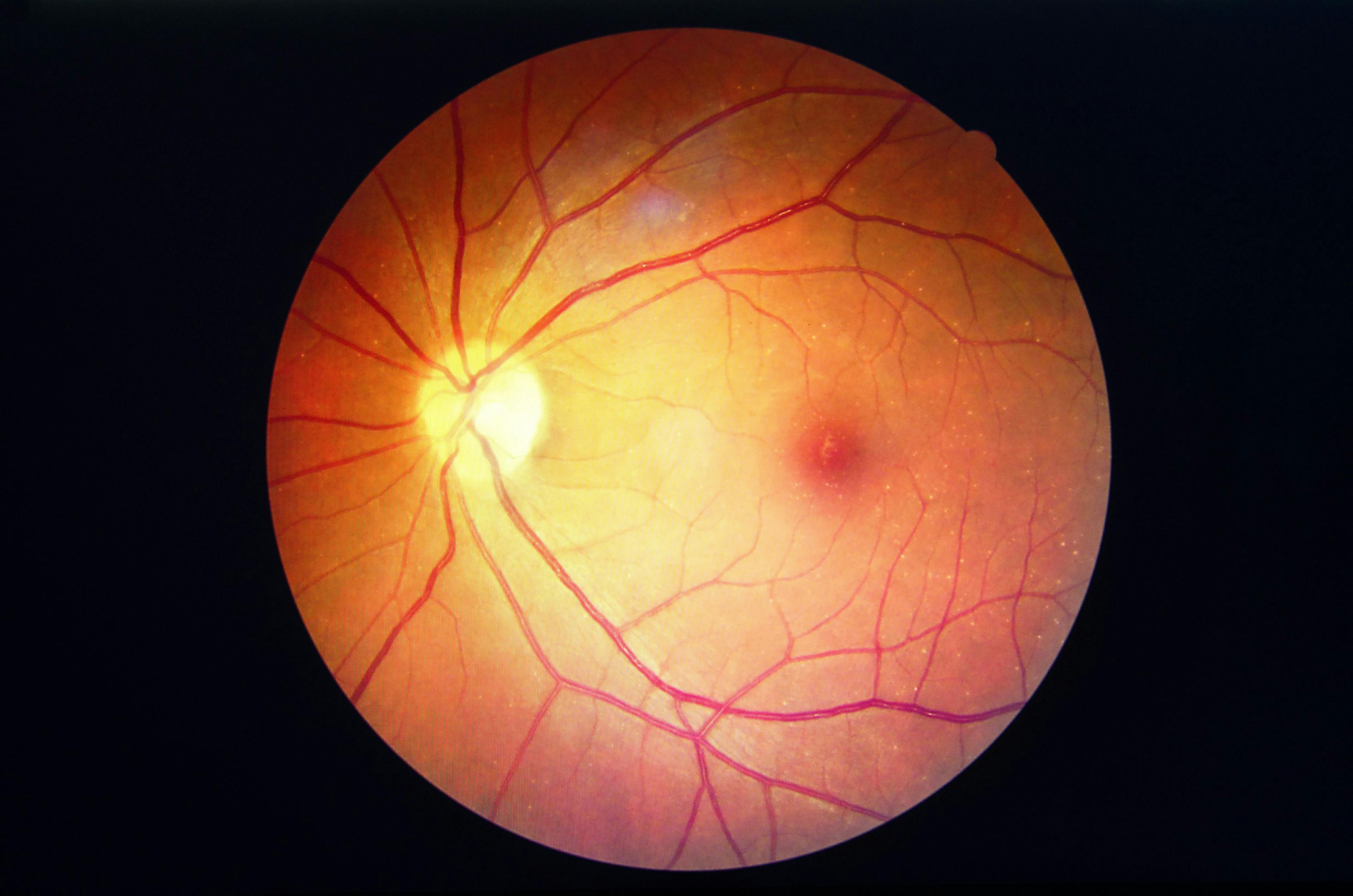 A Blood Test May Help Identify Those at Risk for Diabetic Retinopathy