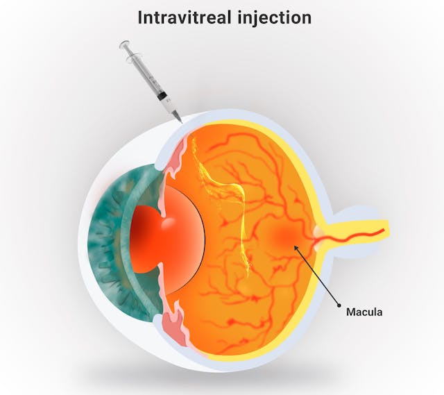 Illustration of intravitreal injection | Image credit: © AngelaSouza  stock.adobe.com