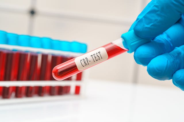 Blood Tests May Help Identify IBD in Preclinical Phases