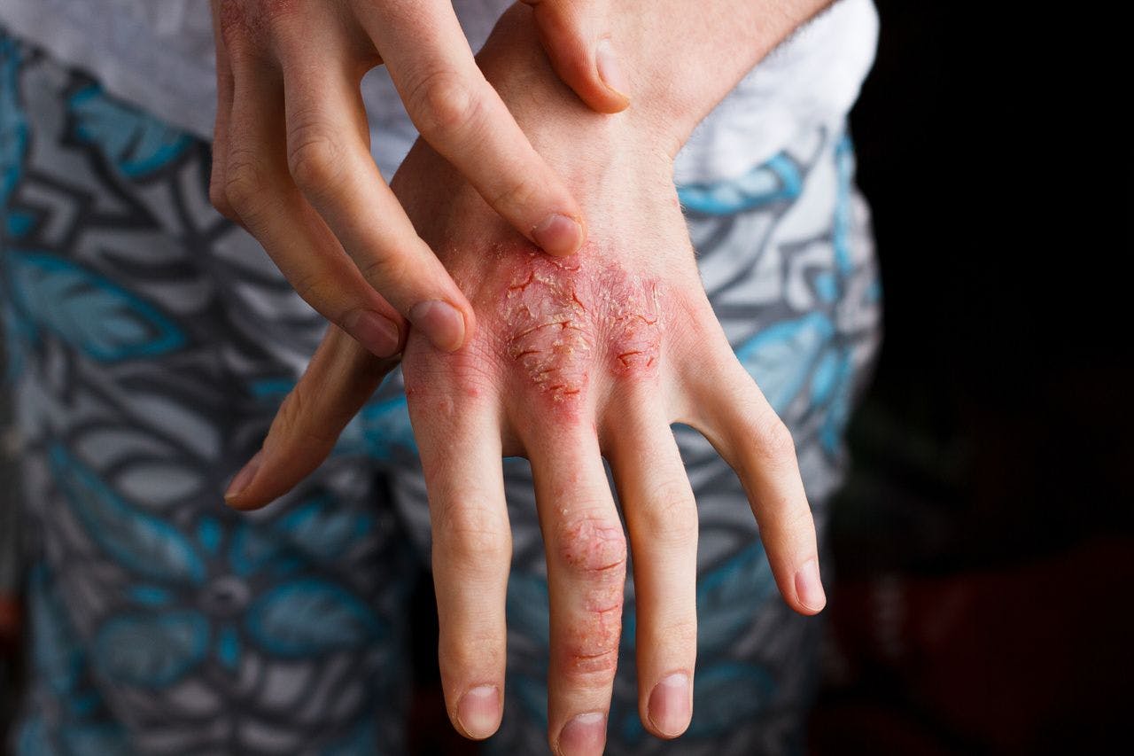 Real-World Data: Psoriatic Arthritis Patients Stay on Cosentyx After Other Options Fail