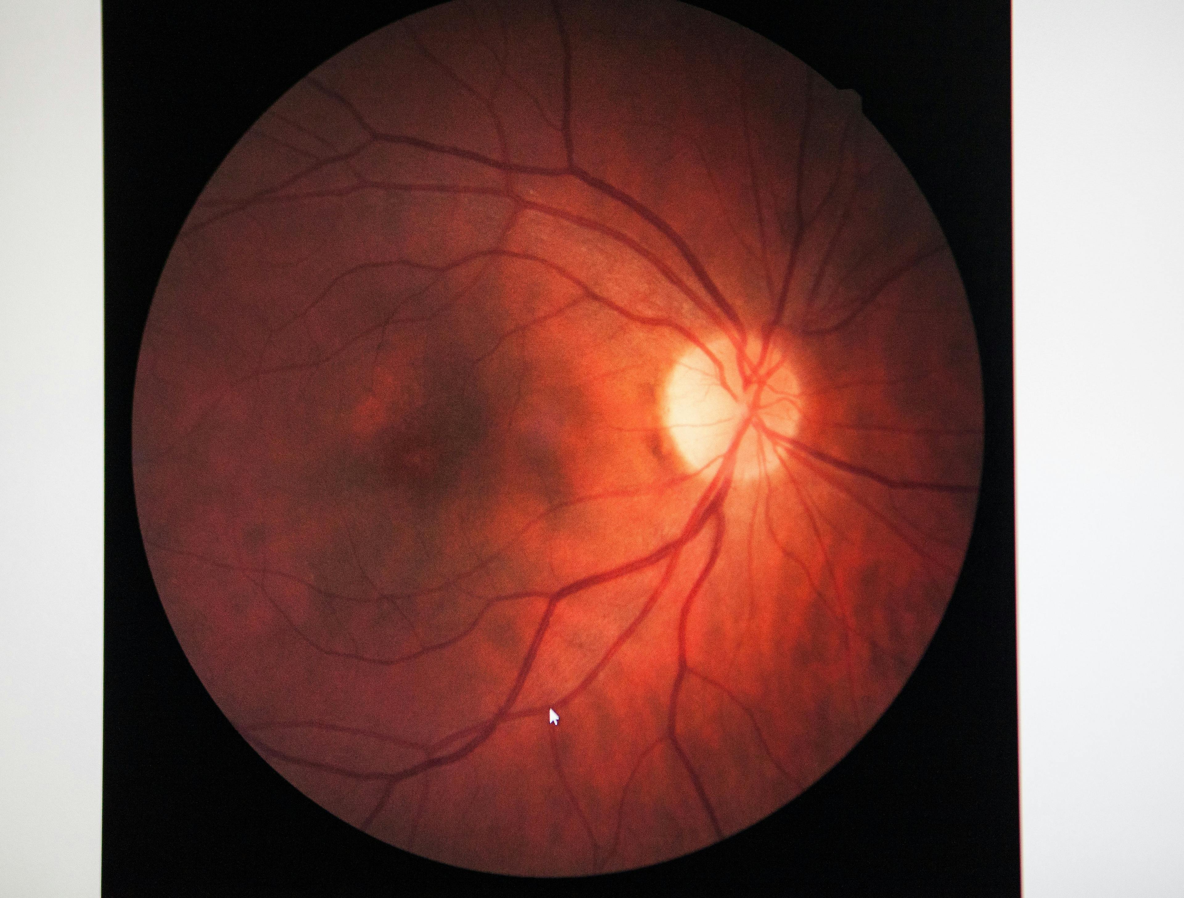  Positive Long-term Results Seen with Vabysmo in Retinal Vein Occlusion