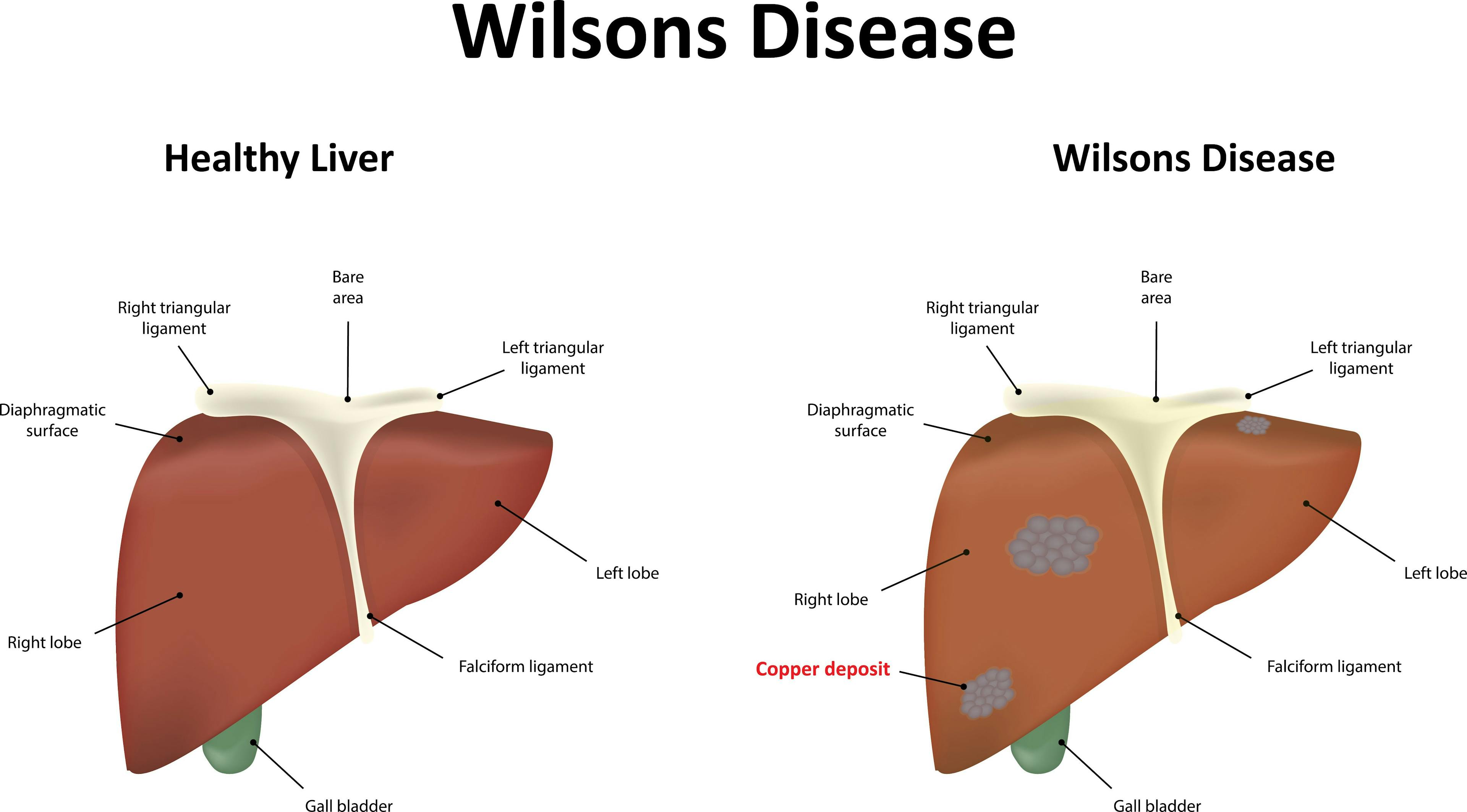 Gene Therapy Among the New Possible Treatments for Wilson’s Disease, a Rare Liver Disease