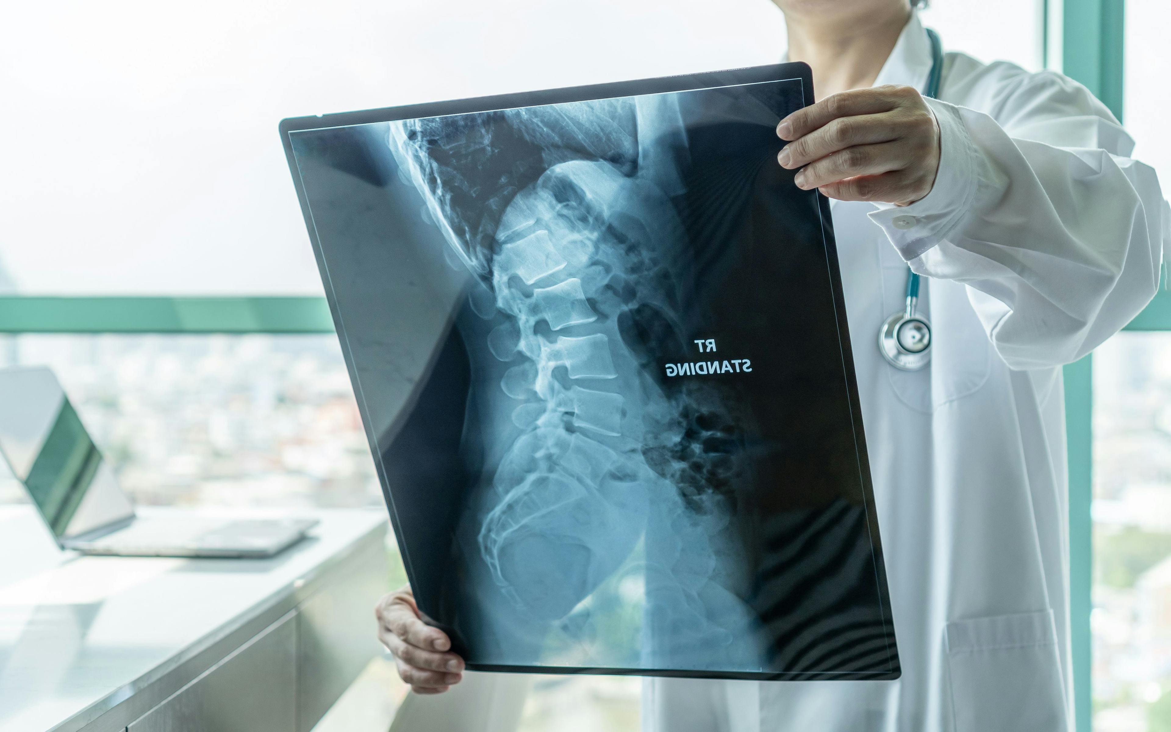 Phase 2 Trial Drug Apitegromab Shows Progress for Spinal Muscular Atrophy Patients 