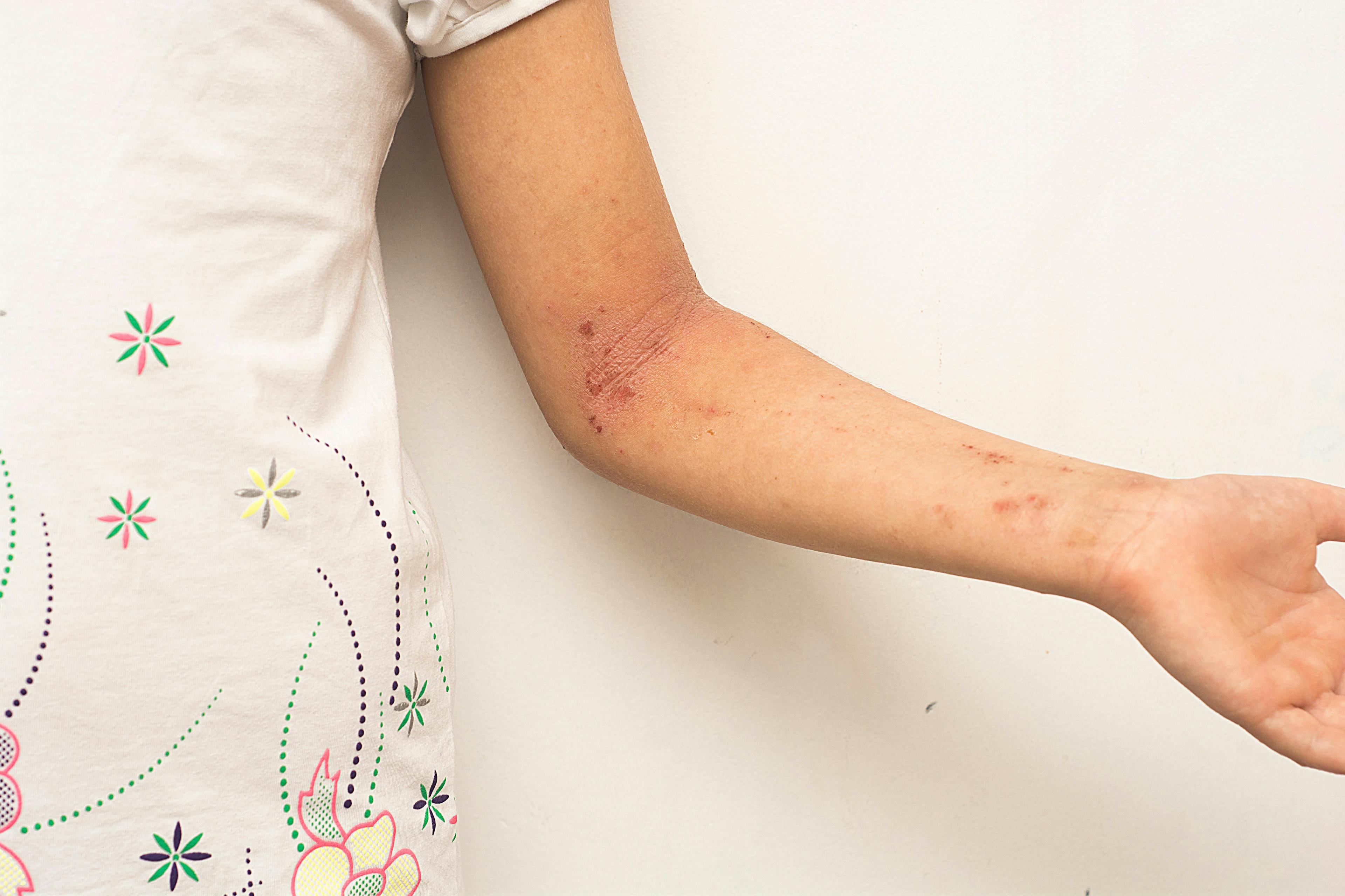 FDA Approves Zoryve for Children with Plaque Psoriasis