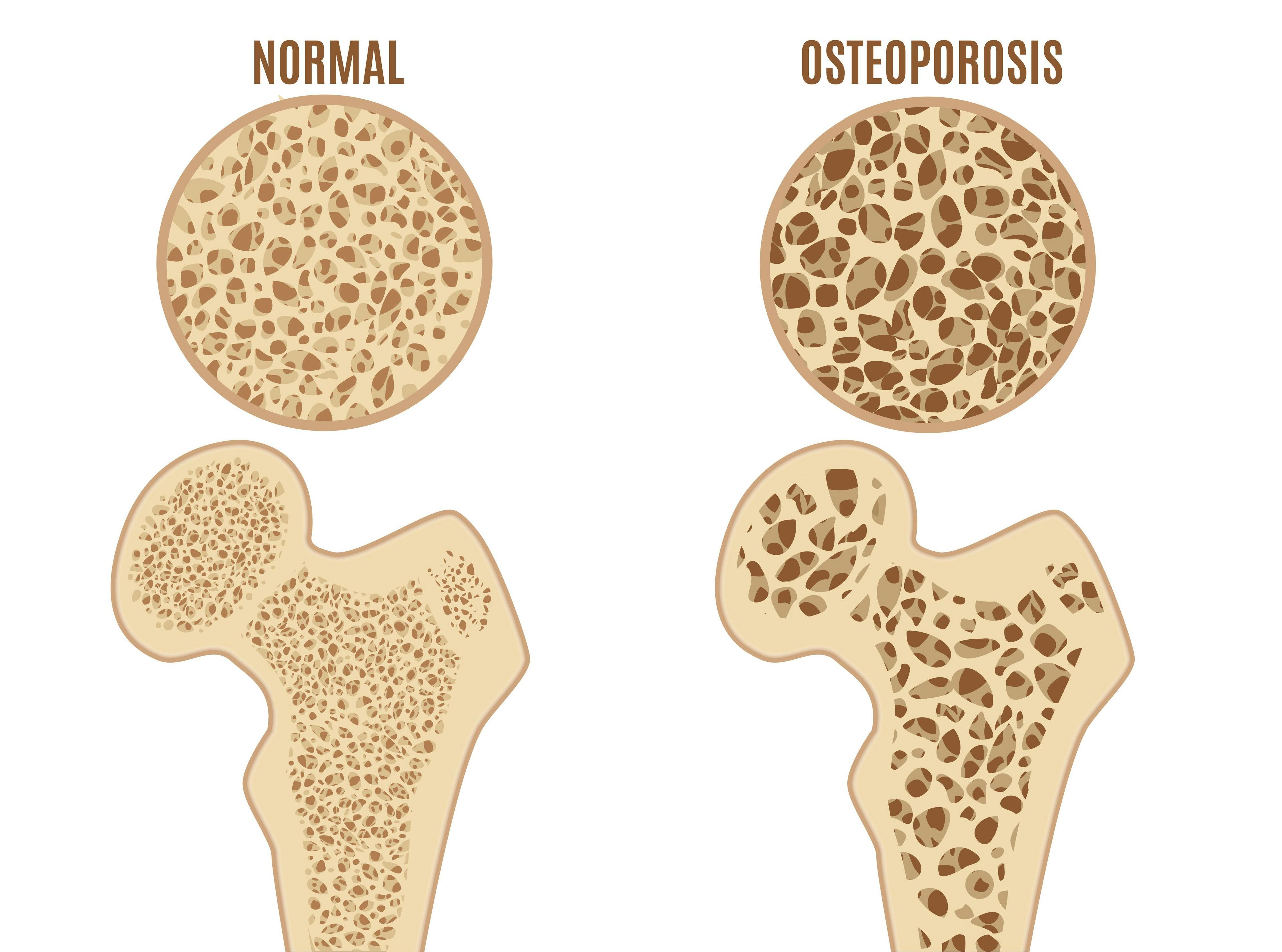 comparison of normal bone to osteoporotic bone | Image credit: ©bigmouse108 stock.adobe.com