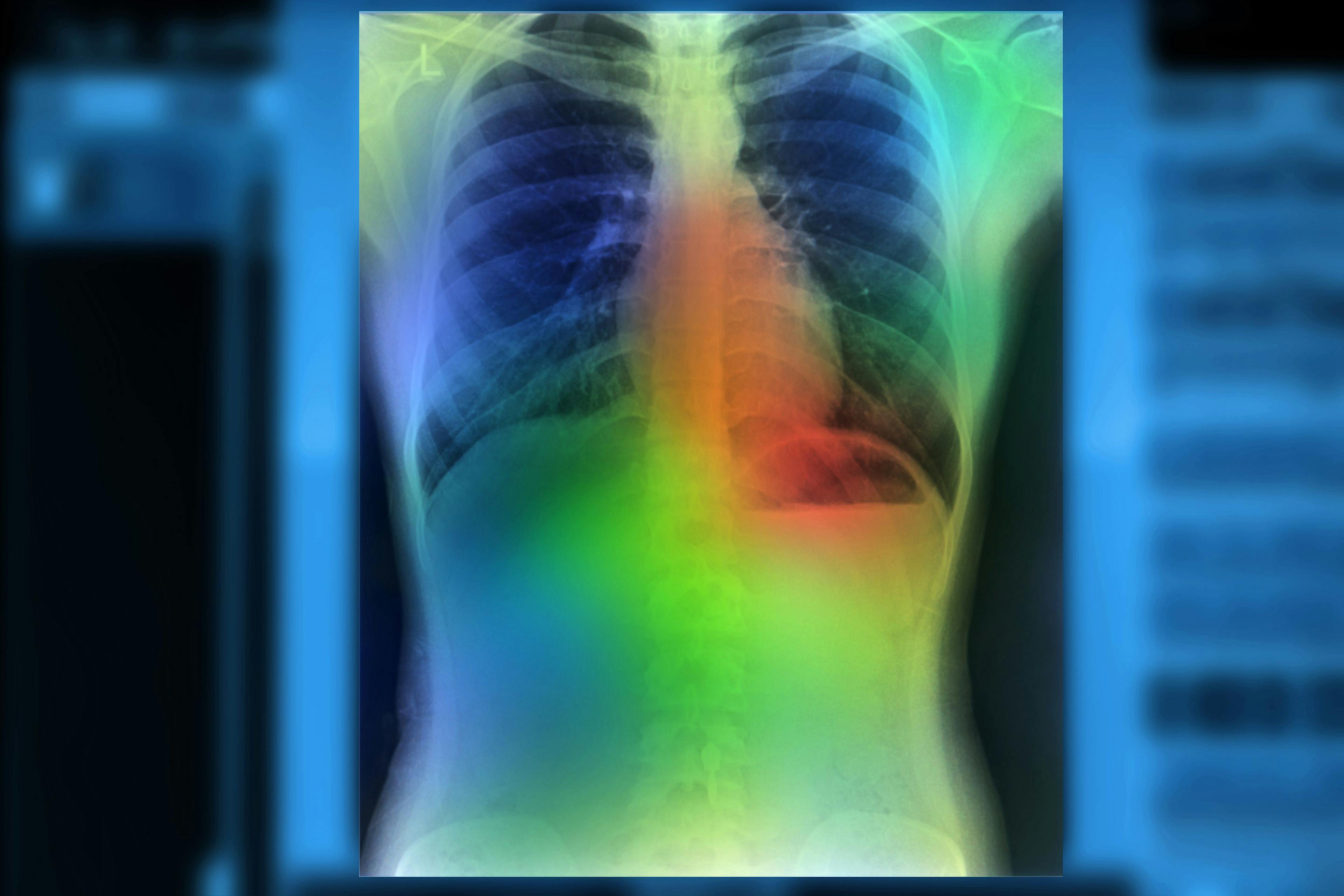New USPSTF Lung Cancer Screening Recommendations Would Double Scans Among Blacks, Women