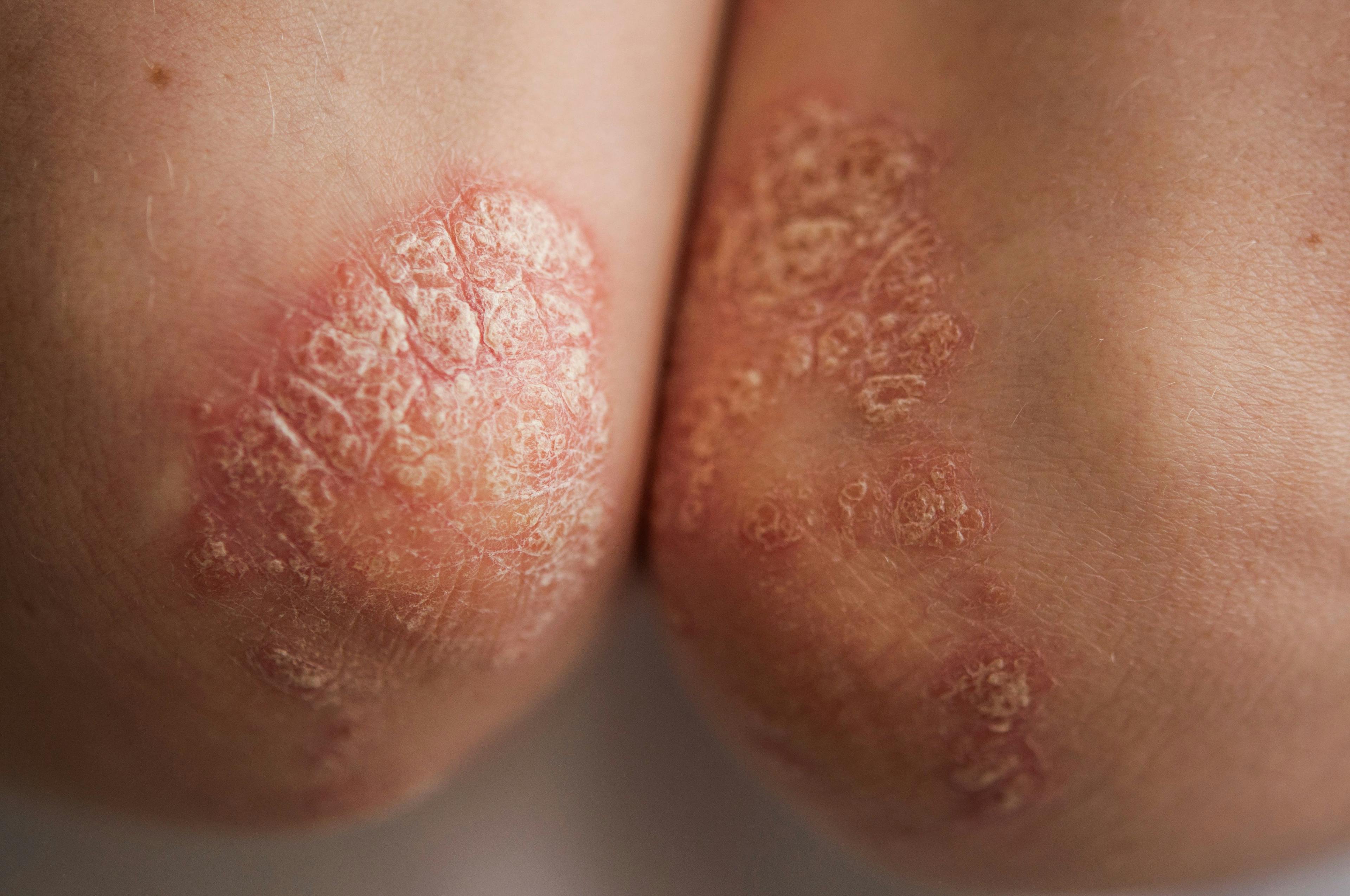 Close up of psoriasis | Image credit: © vadim yerofeyev  stock.adobe.com