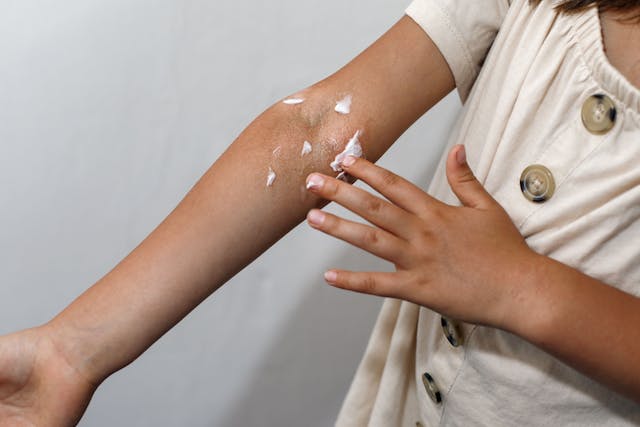 Roflumilast Cream Meets Endpoint in Study of Young Children with Atopic Dermatitis
